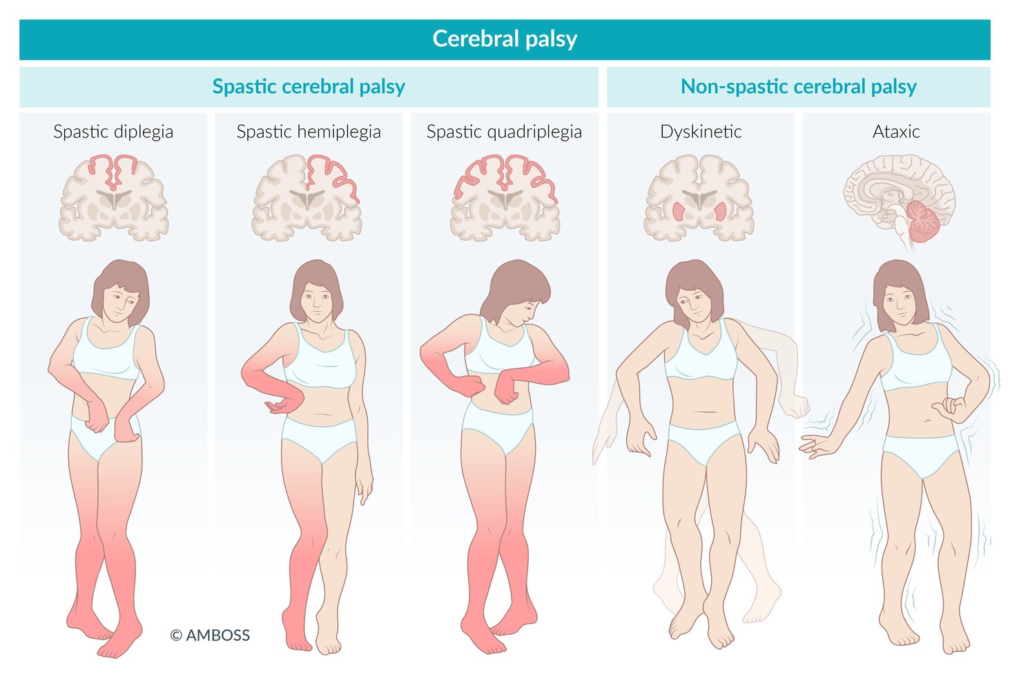 Types of cerebral palsy