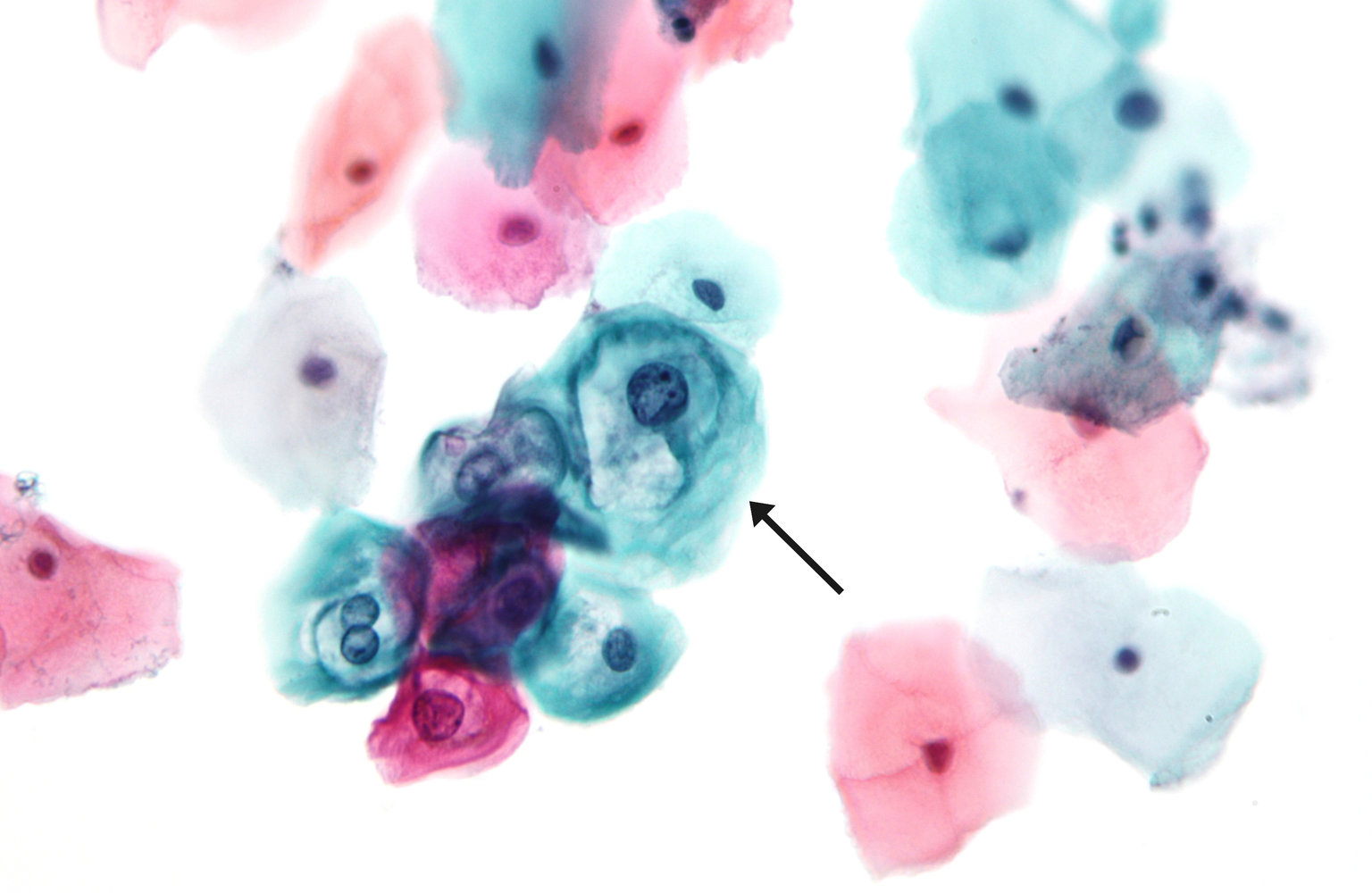 Pap smear showing low-grade dysplasia