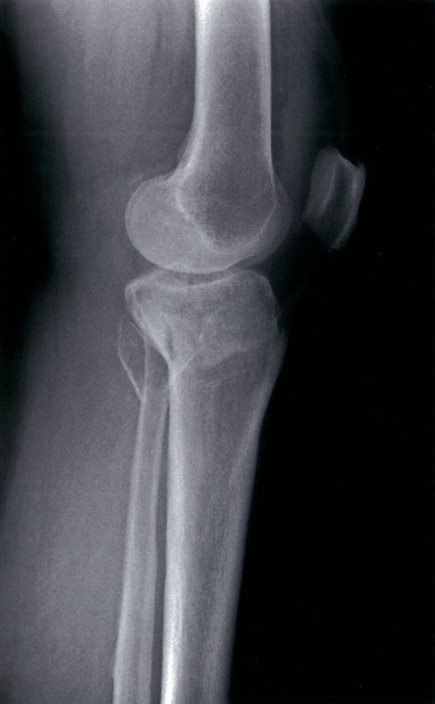 Tibial plateau and fibular fractures (2/2)