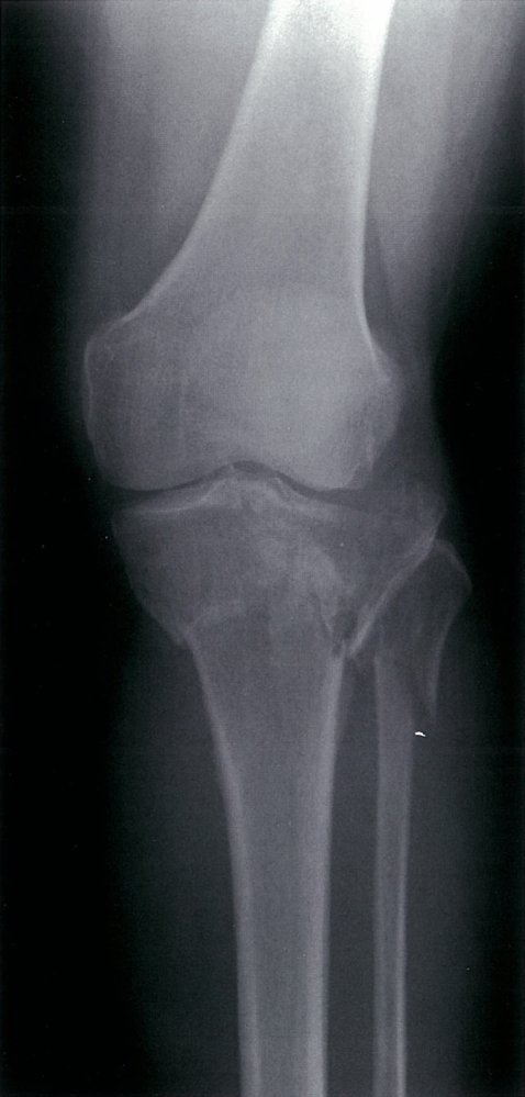 Tibial plateau and fibular fractures (1/2)
