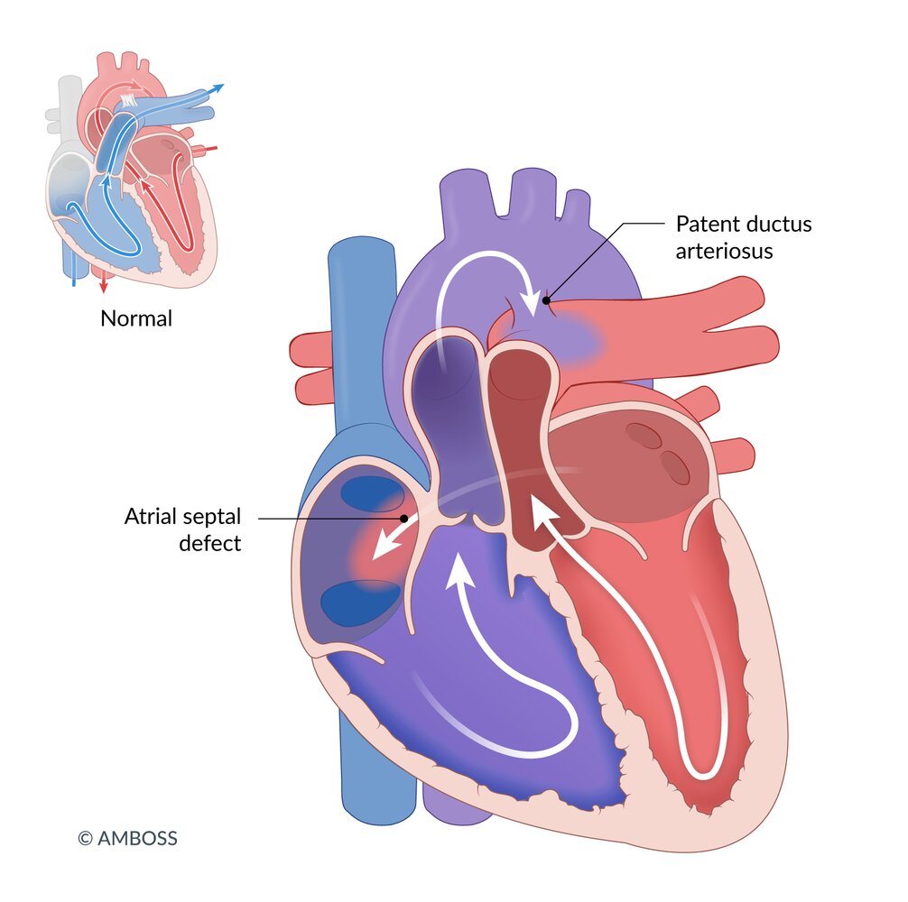 Intracardiac shunt in the transposition of the great vessels