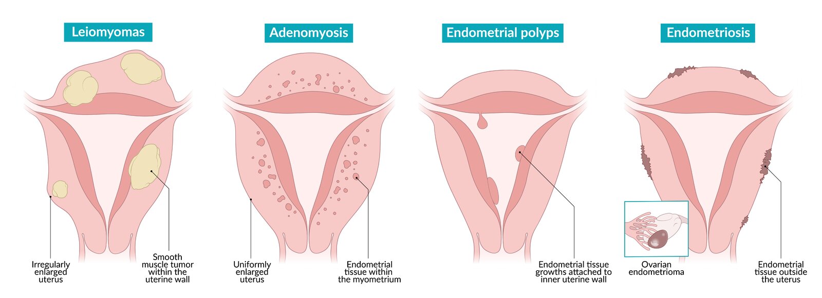 Benign conditions of the uterus