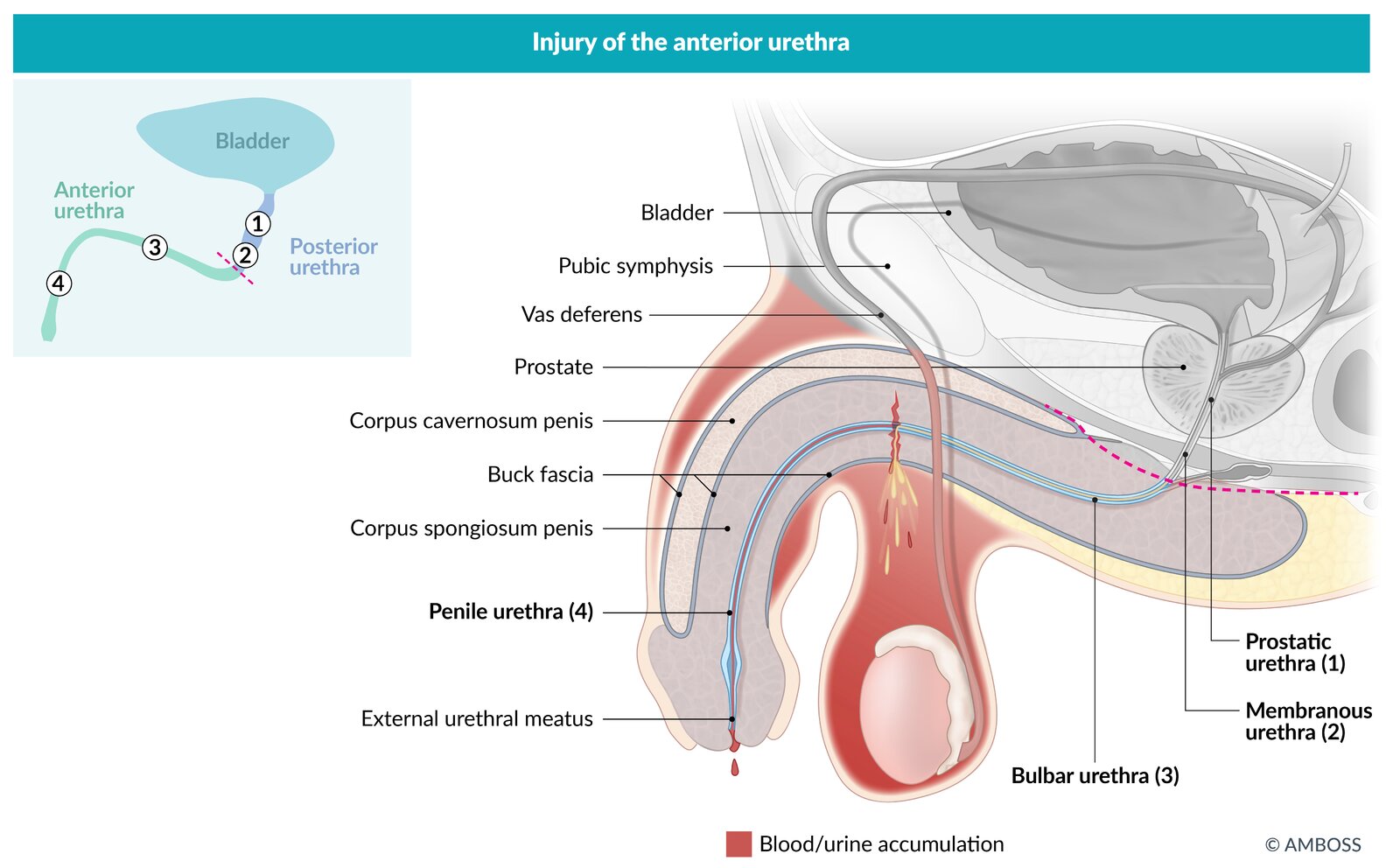 Injury of the anterior urethra