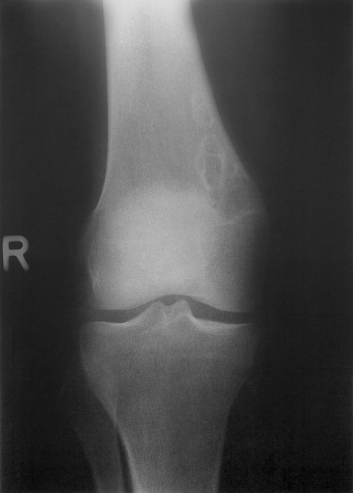 Nonossifying fibroma