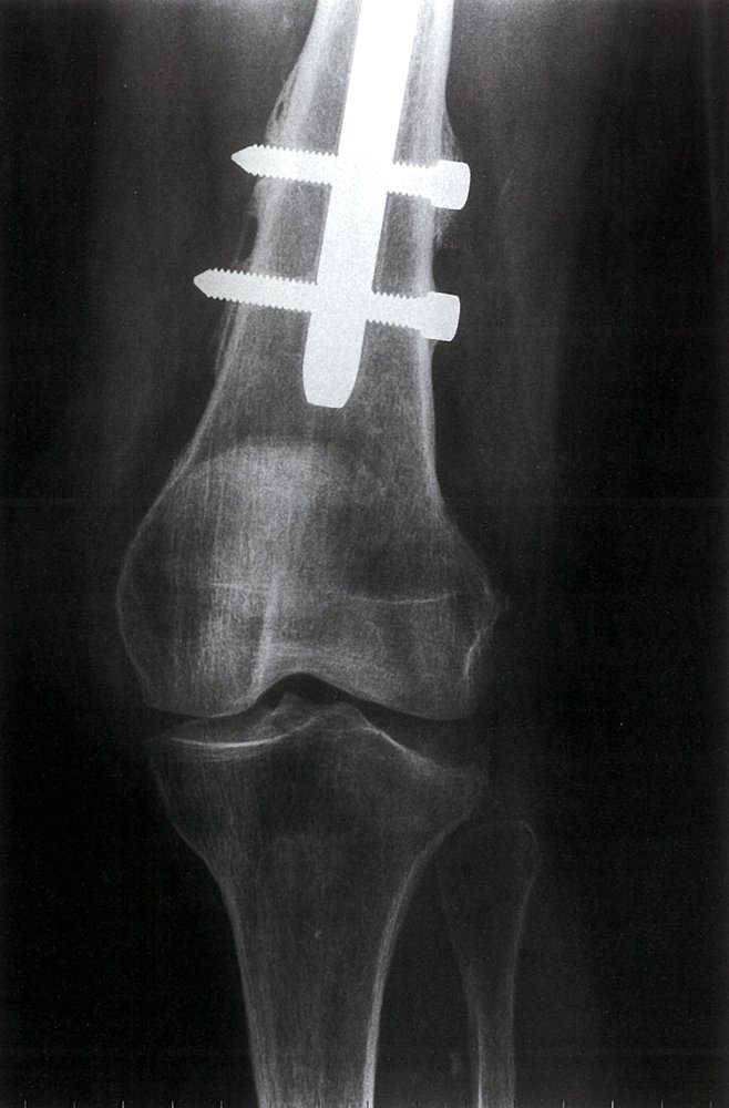 Lateral tibial plateau depression fracture