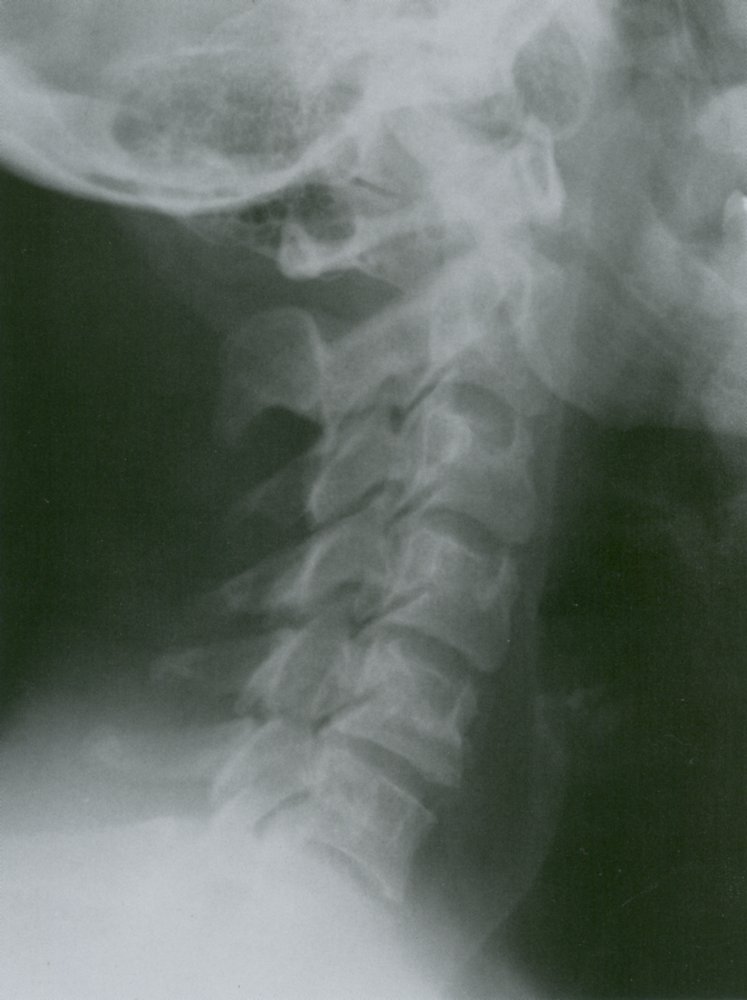 Cervical spine lateral view