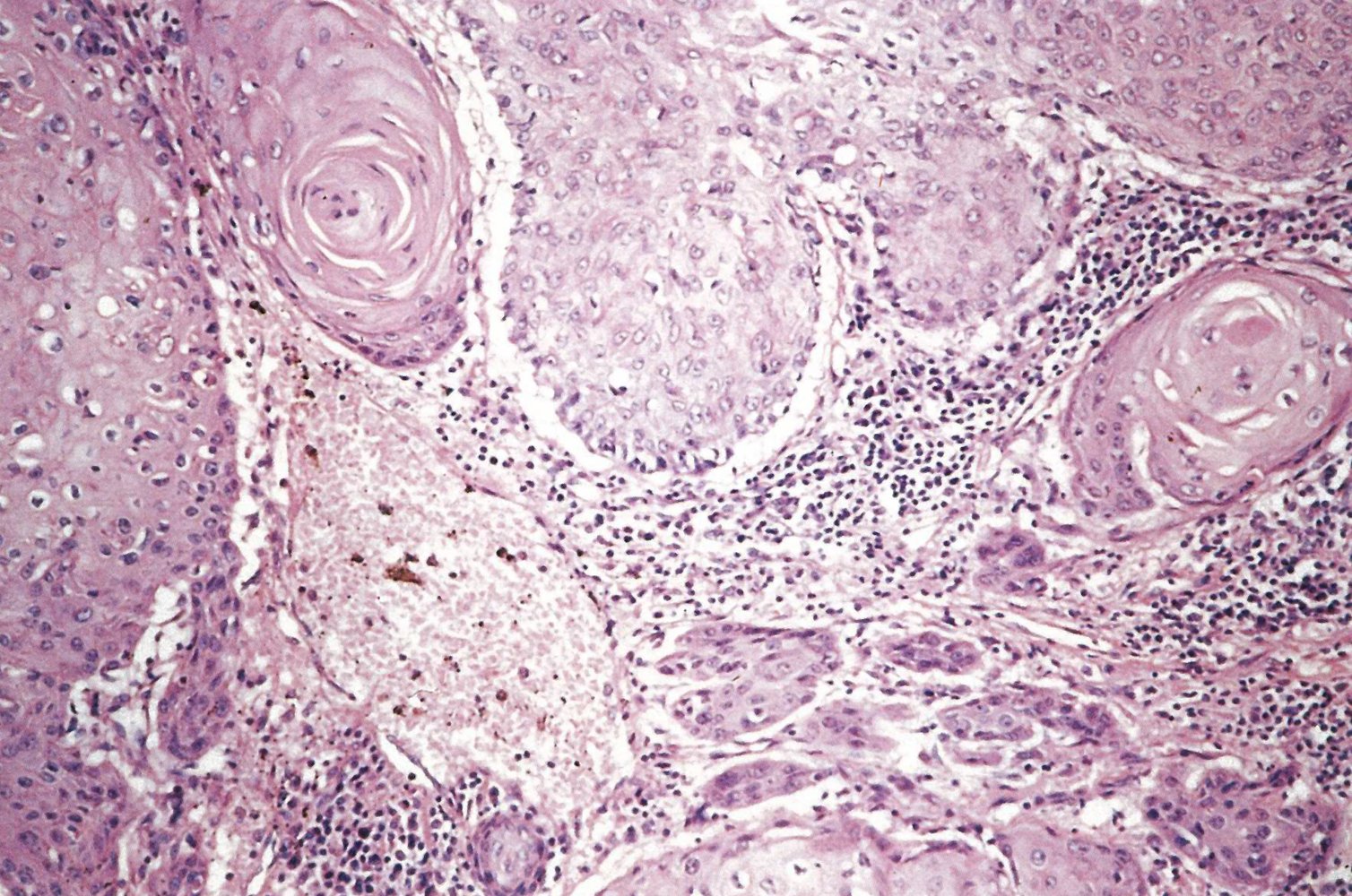 Keratinizing squamous cell carcinoma of the esophagus