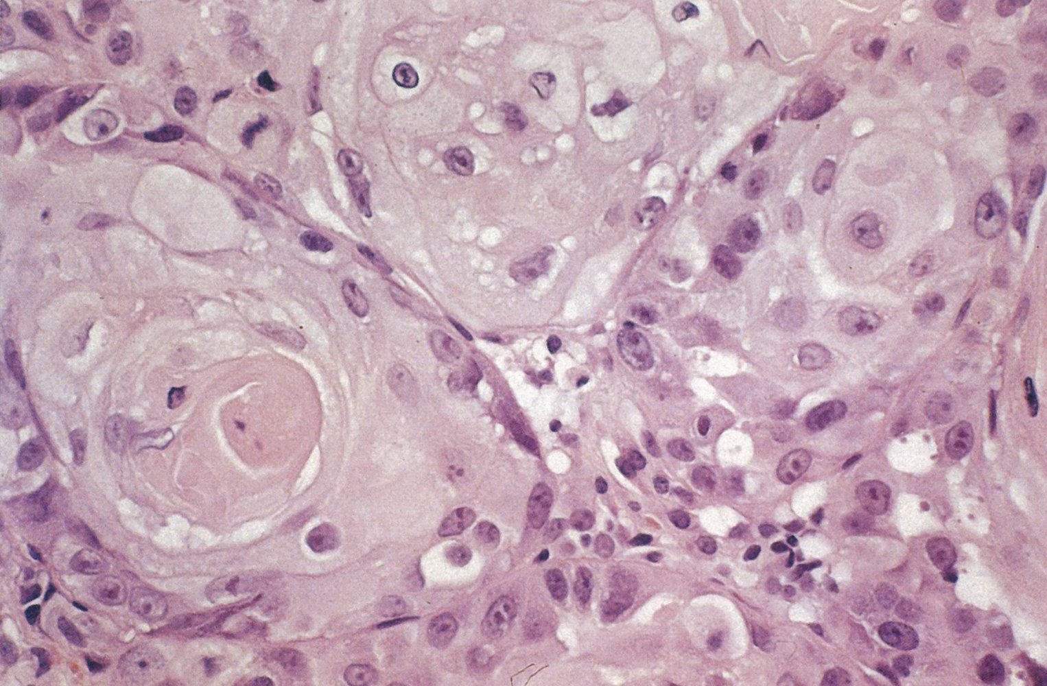 Keratinizing squamous cell carcinoma of the esophagus
