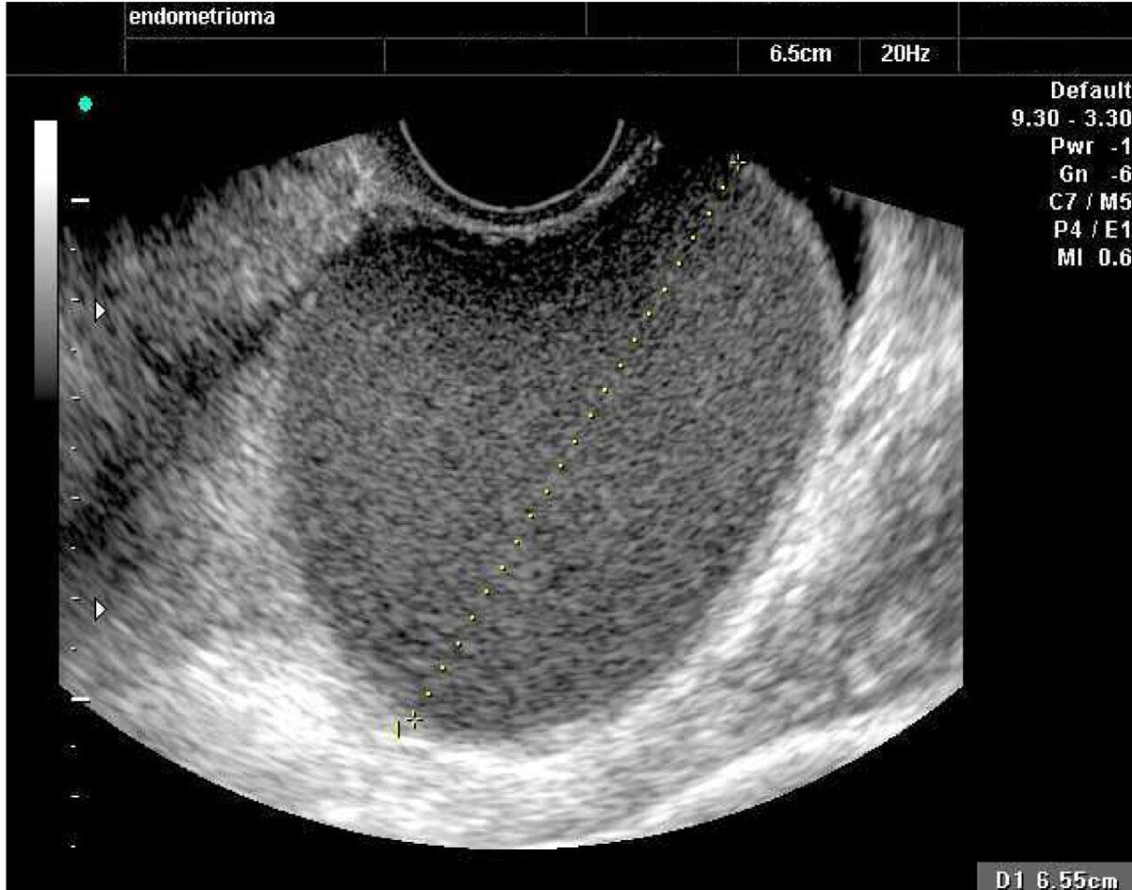 Endometrioma (chocolate cyst)