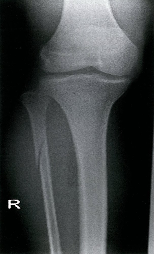 Proximal fibular fracture (1/2)