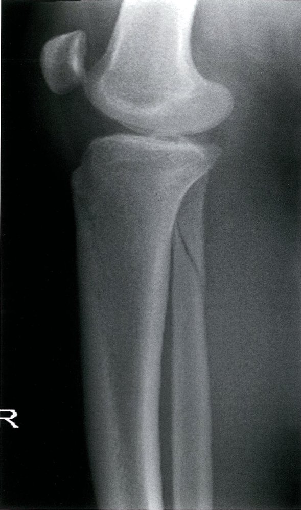 Proximal fibular fracture (2/2)