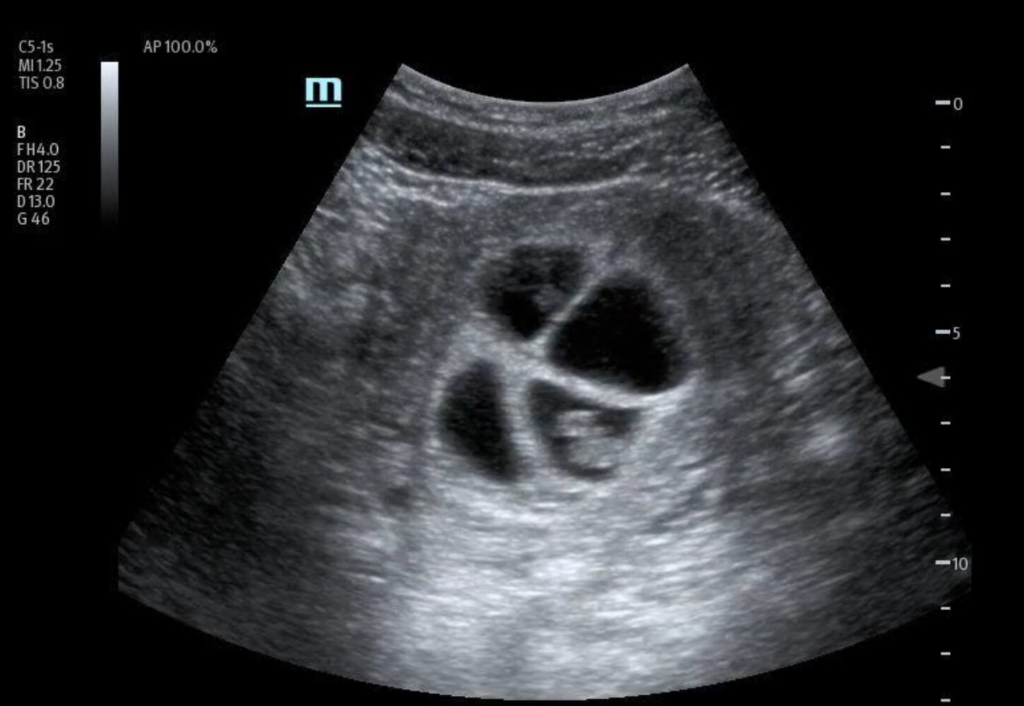 Early multiple gestation pregnancy