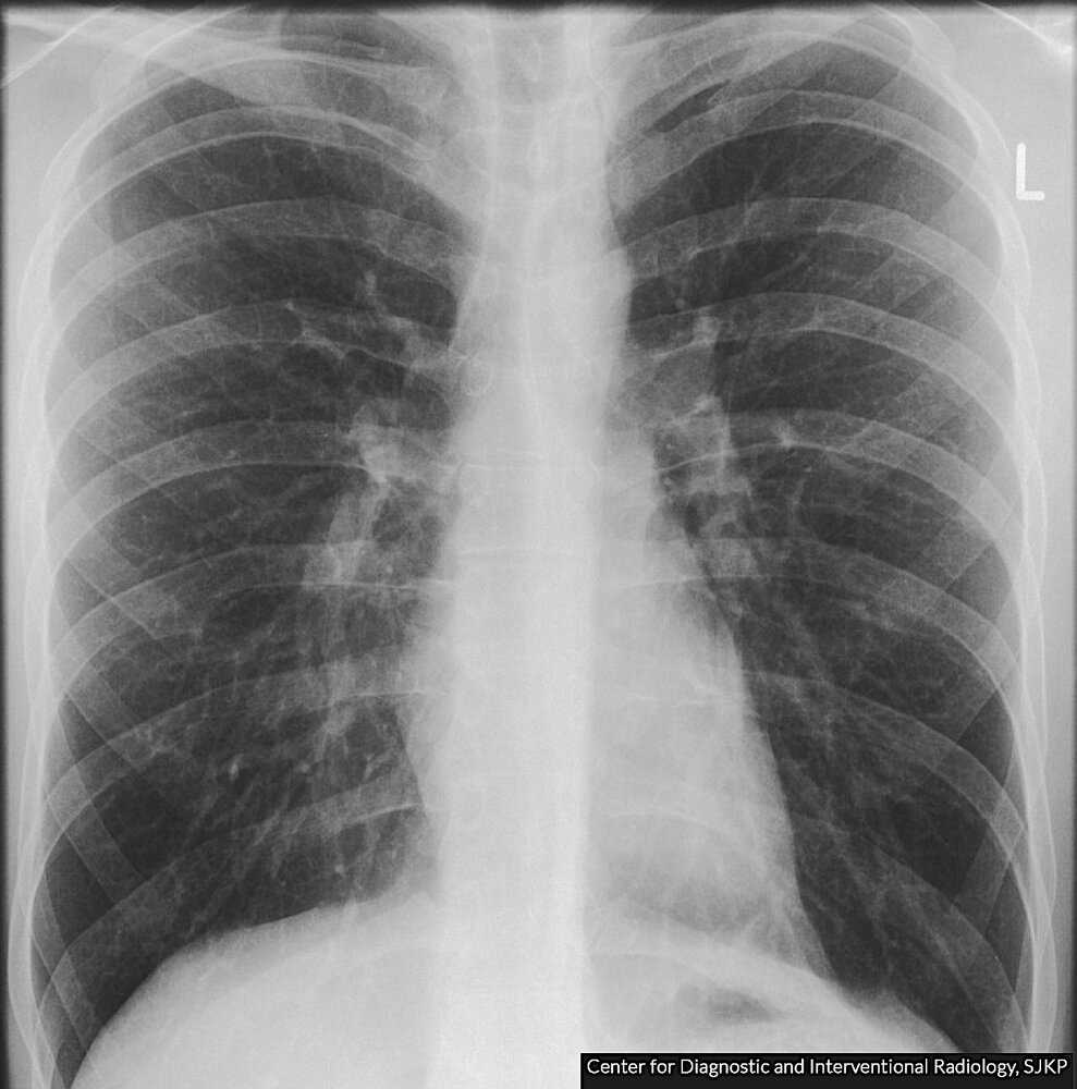 Normal pulmonary hila