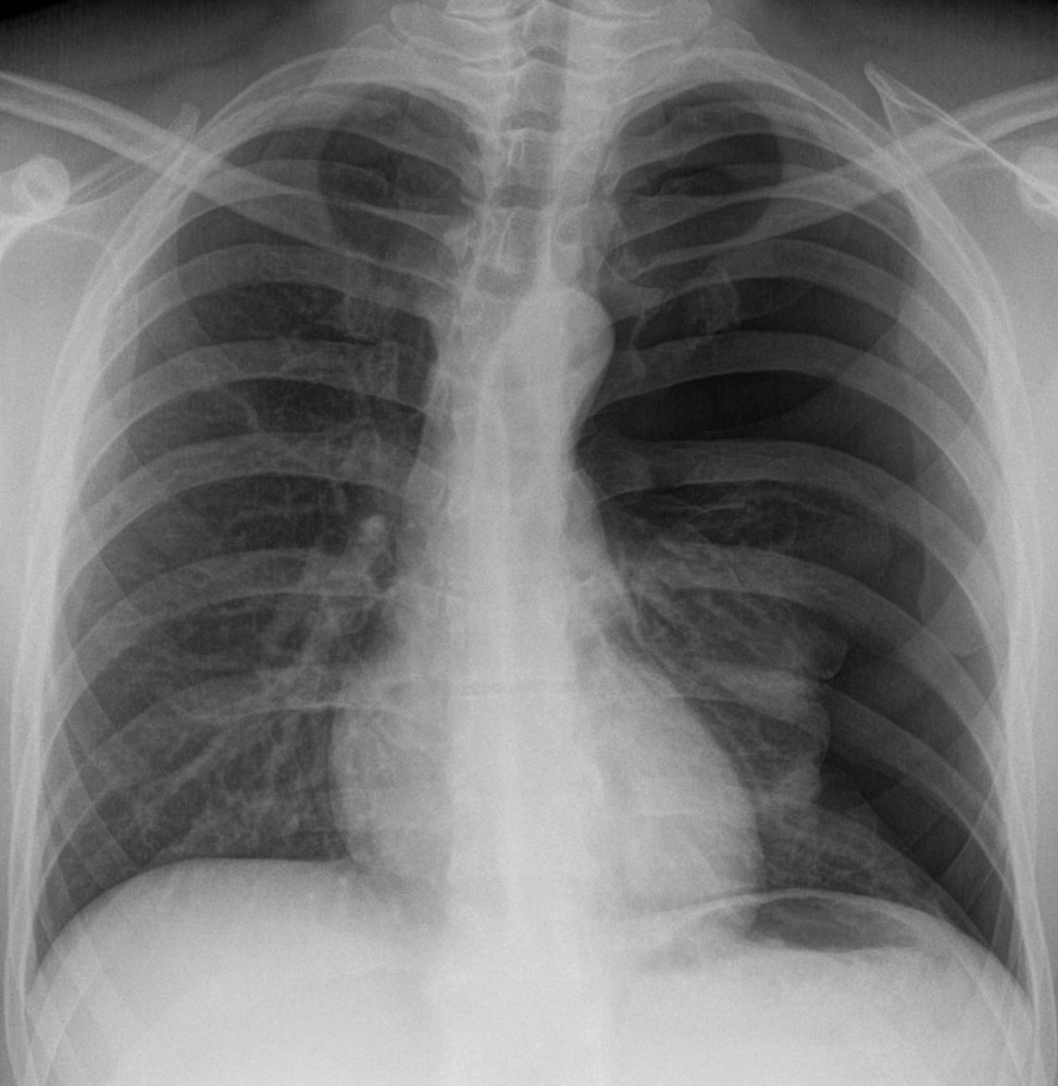 Tension pneumothorax