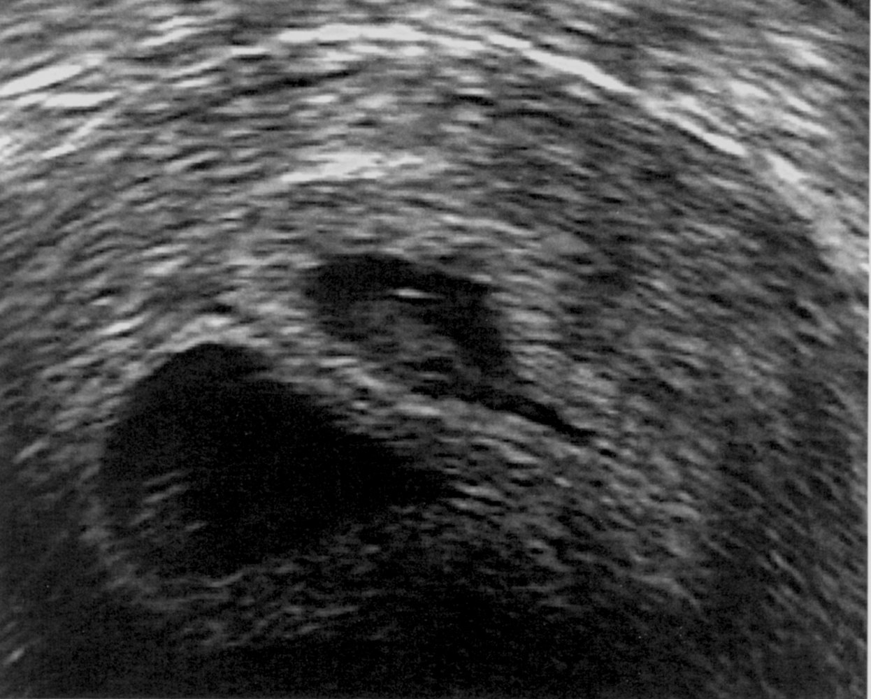 Lambda sign in dichorionic diamniotic twin pregnancy