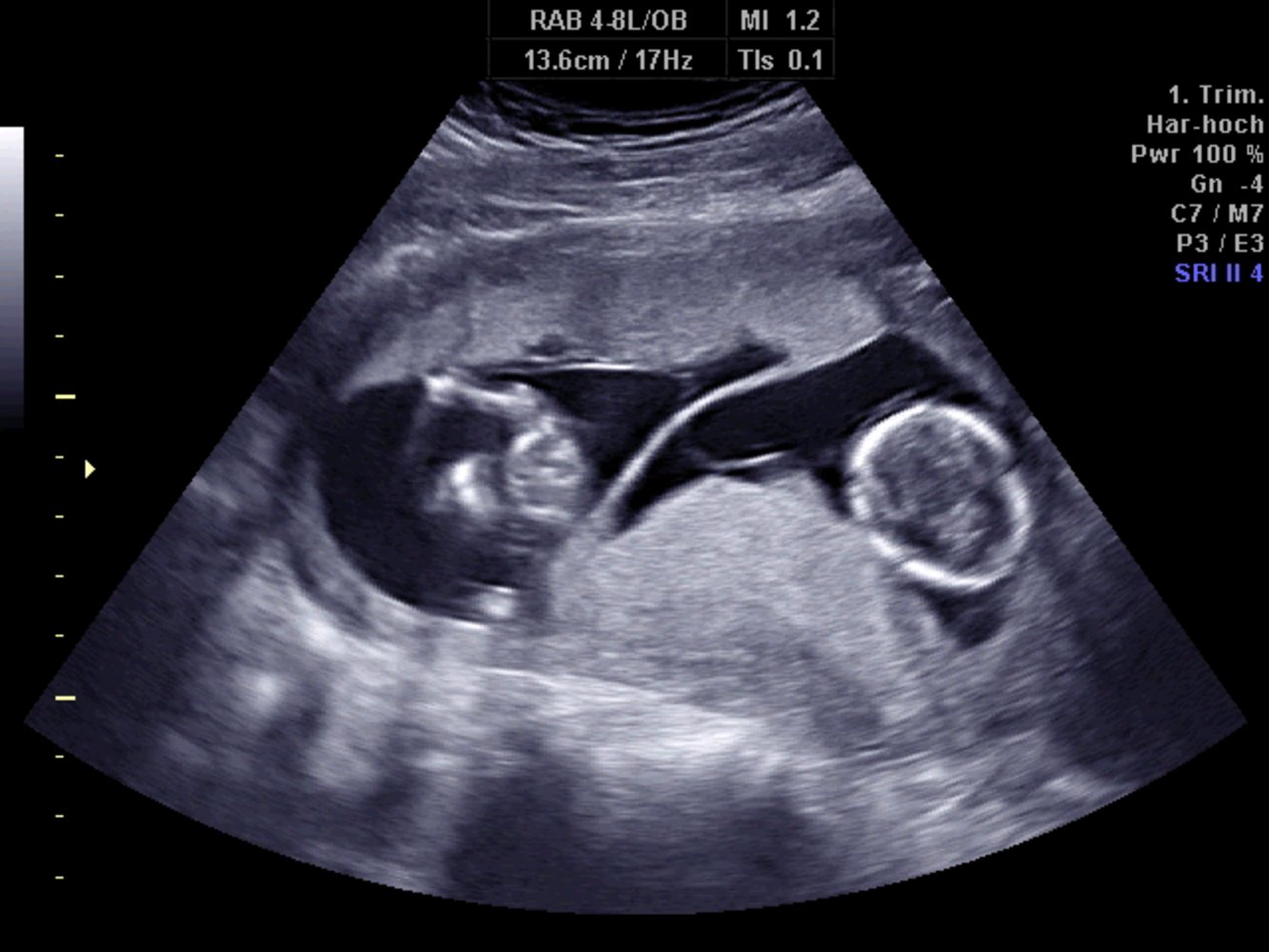 Lambda sign (twin peak sign) in twin pregnancy