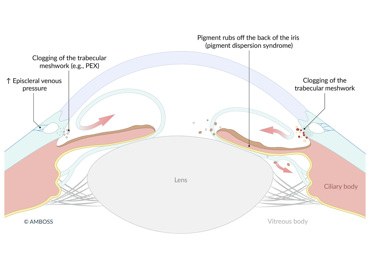 Etiology and pathogenesis of secondary open-angle glaucoma