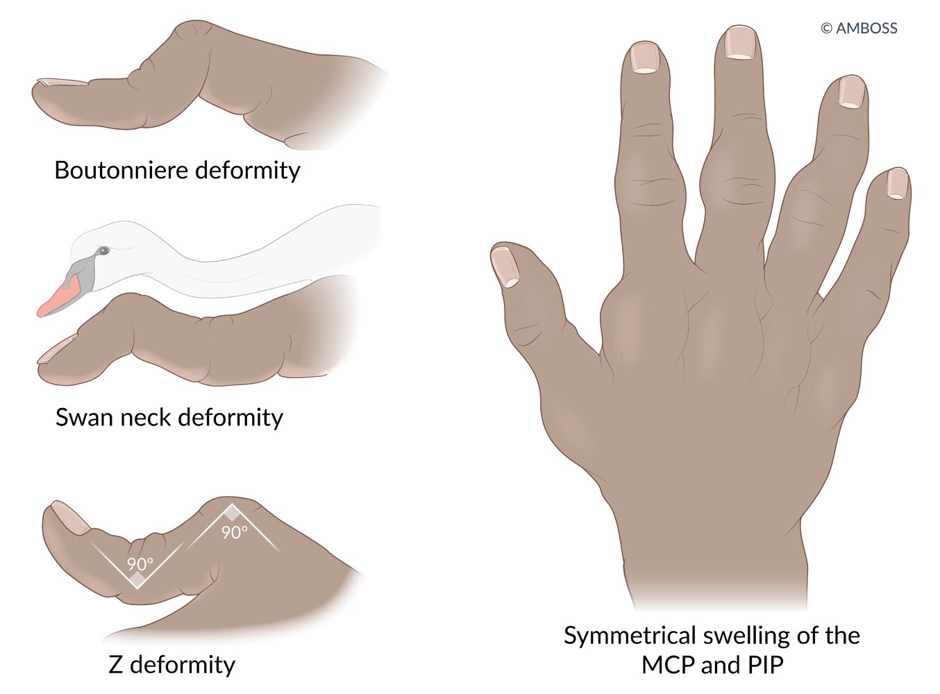Hand deformities in rheumatoid arthritis