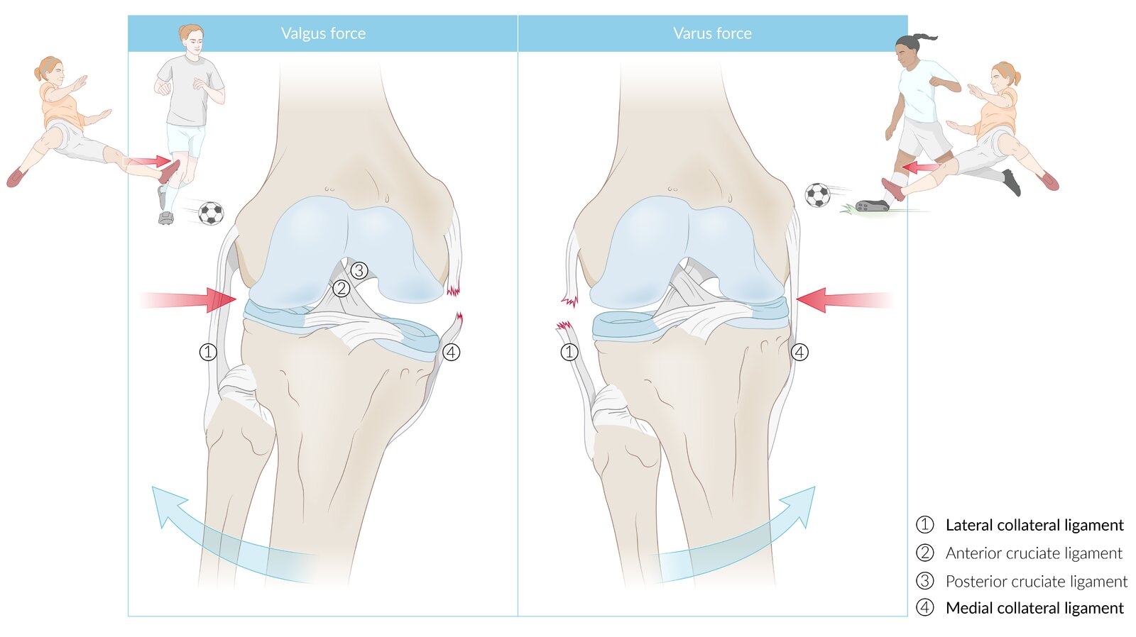 Collateral ligament injuries