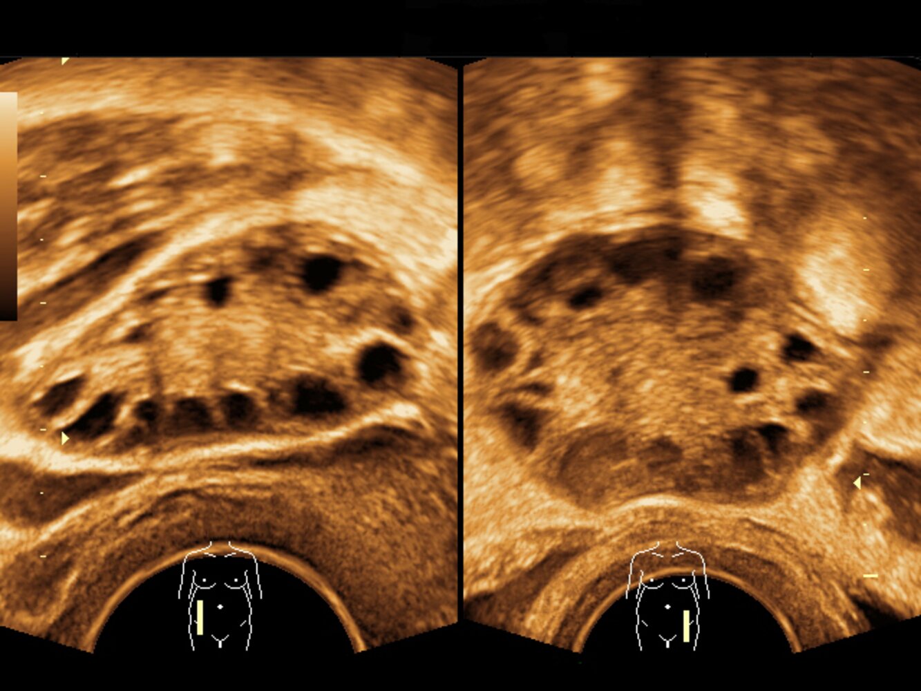 Polycystic ovarian morphology (PCOM)