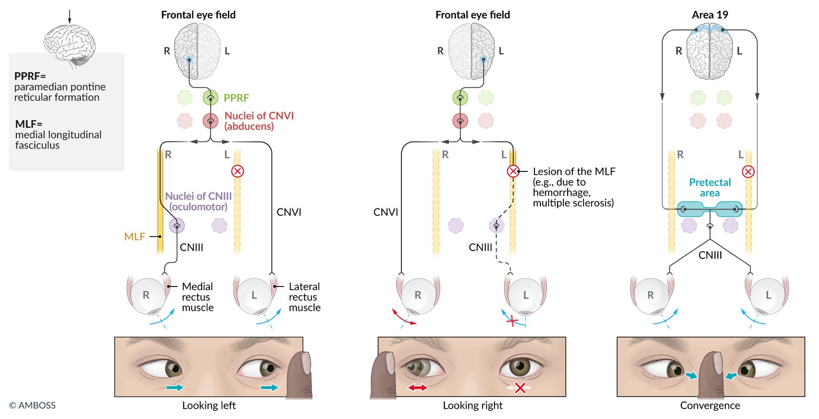 Internuclear ophthalmoplegia