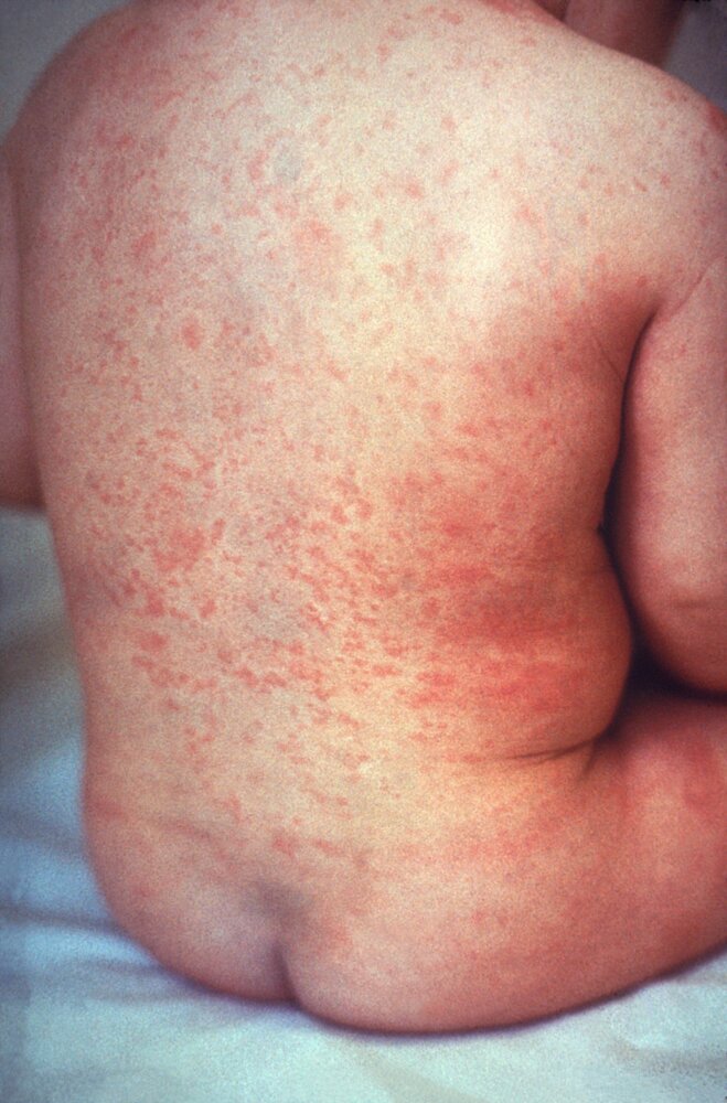 Rubella