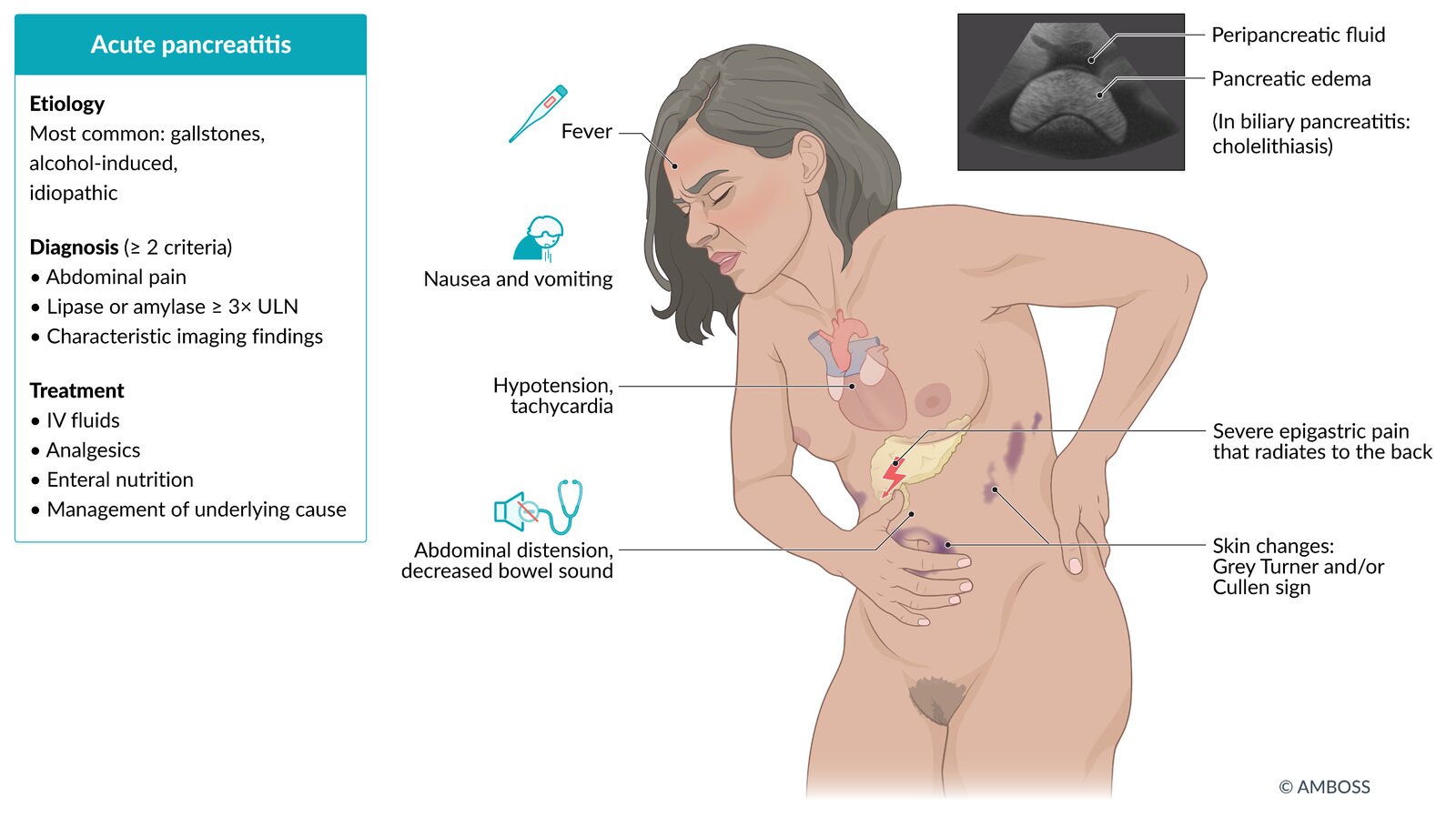 Acute pancreatitis