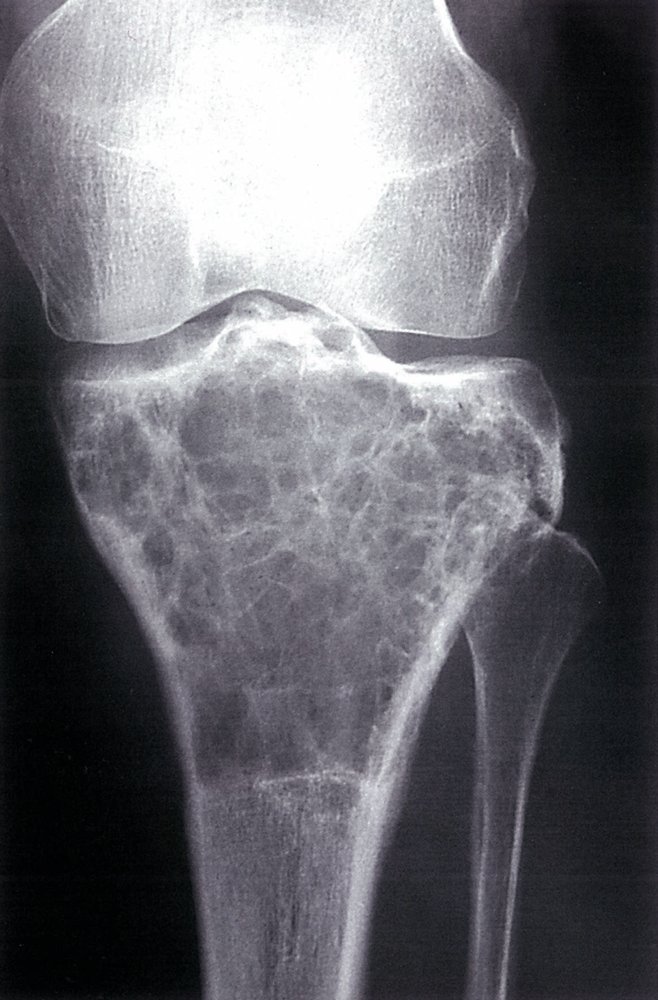 Bubbly bone lesion