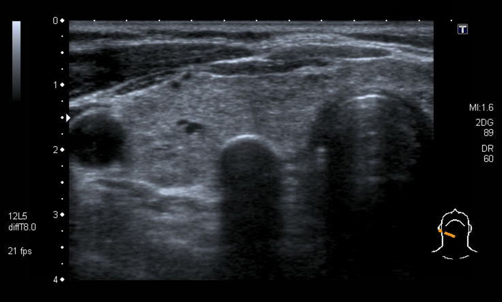 Thyroid nodule with peripheral calcification
