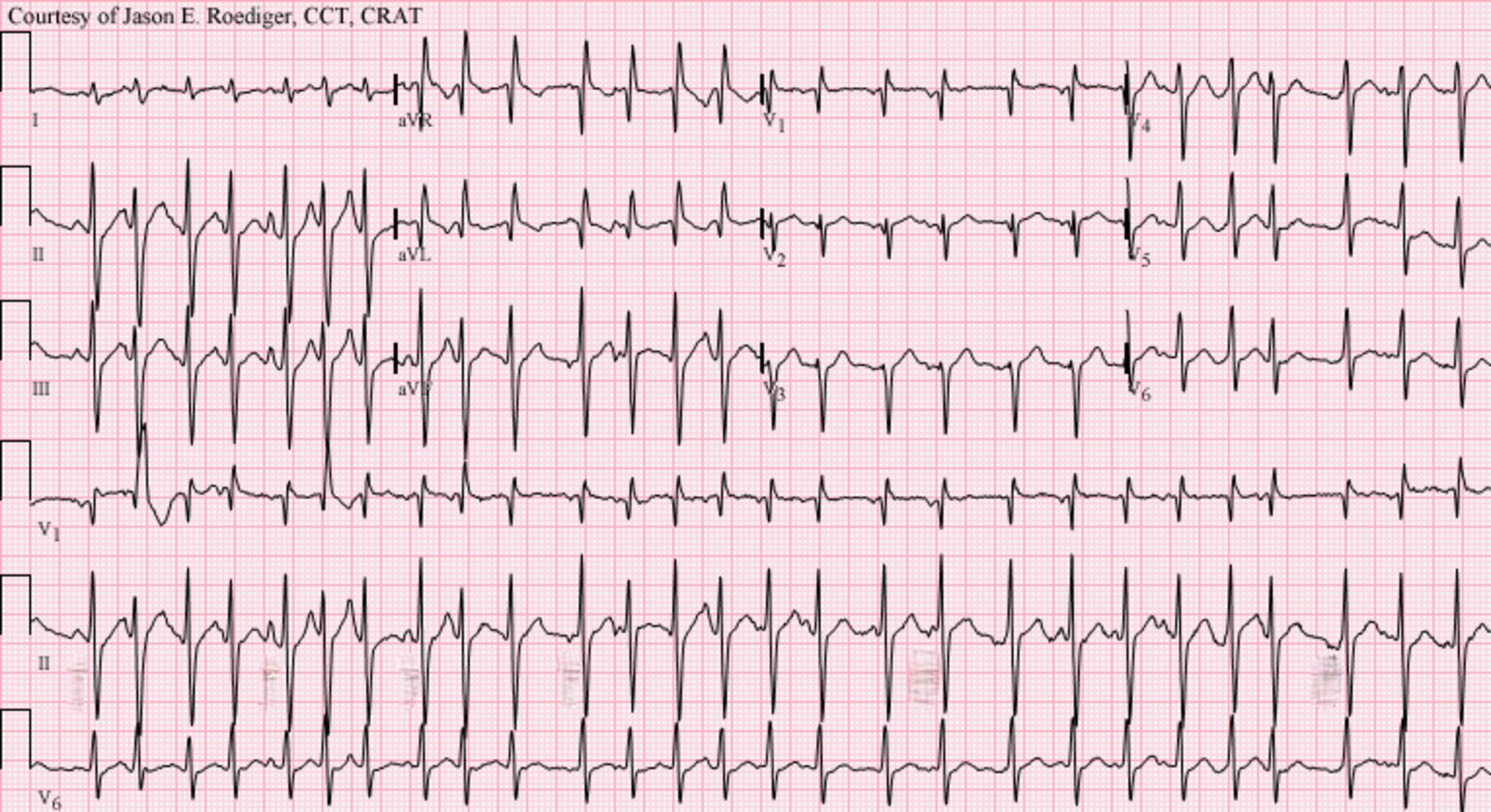 Multifocal atrial tachycardia