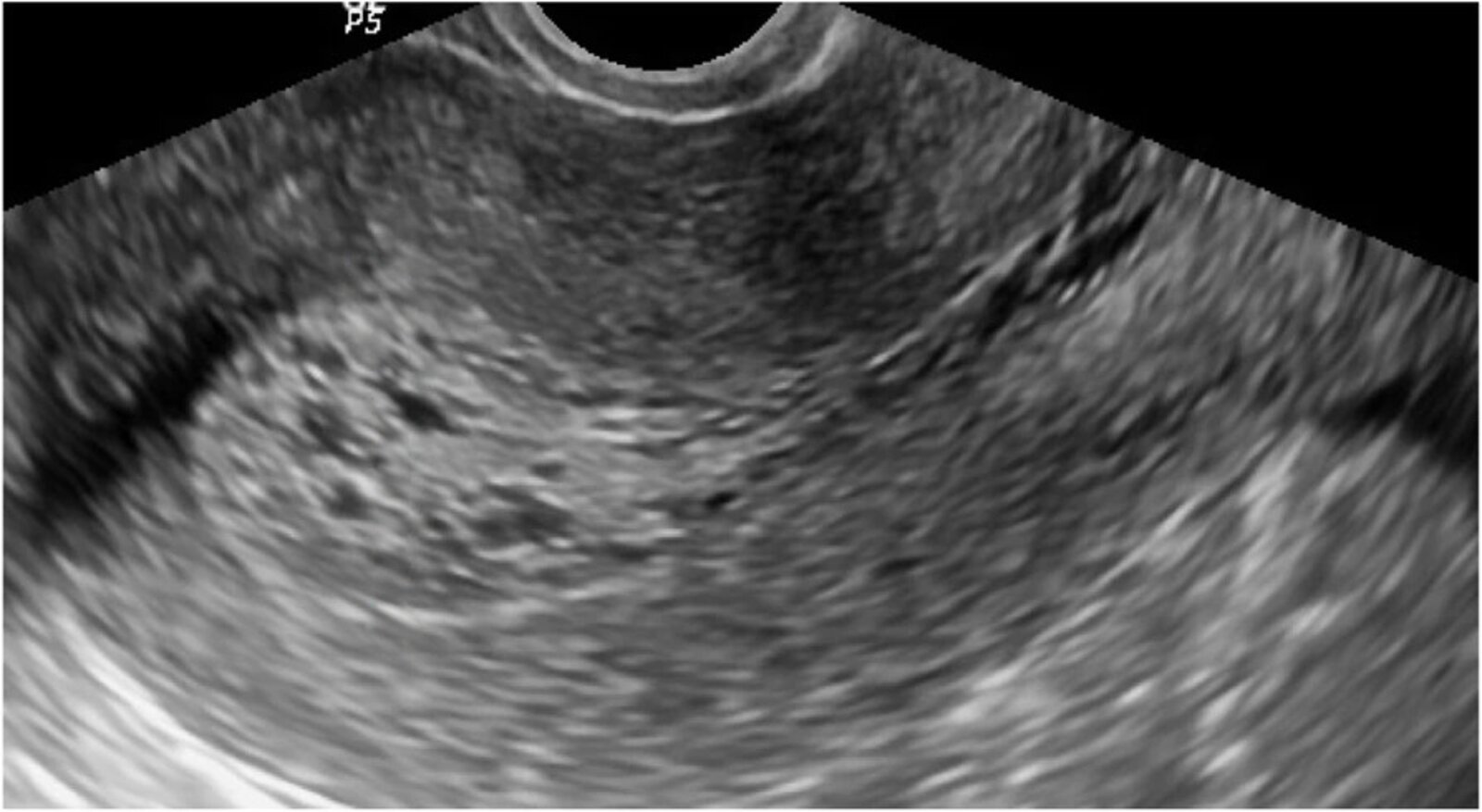 Endometrial thickening with cystic changes