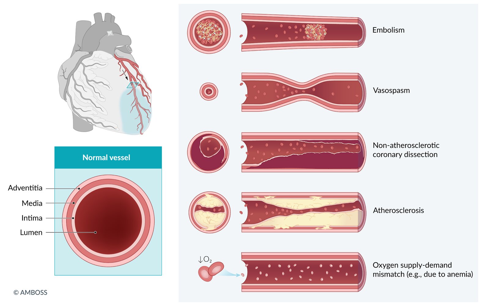 Etiology of acute coronary syndrome