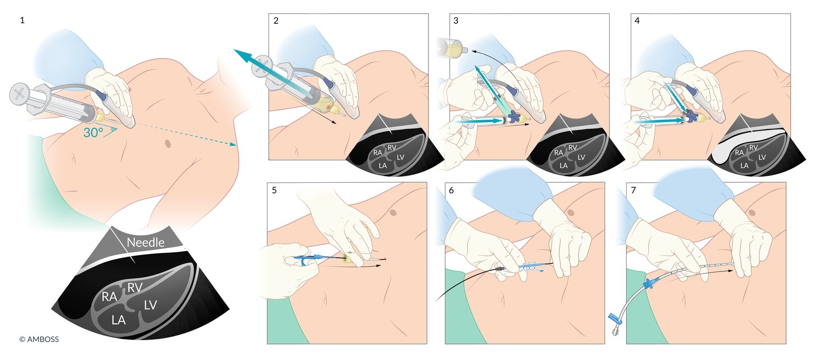 Pericardiocentesis