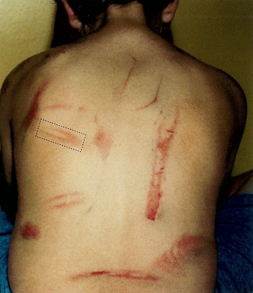 Injuries caused by caning in physical child abuse