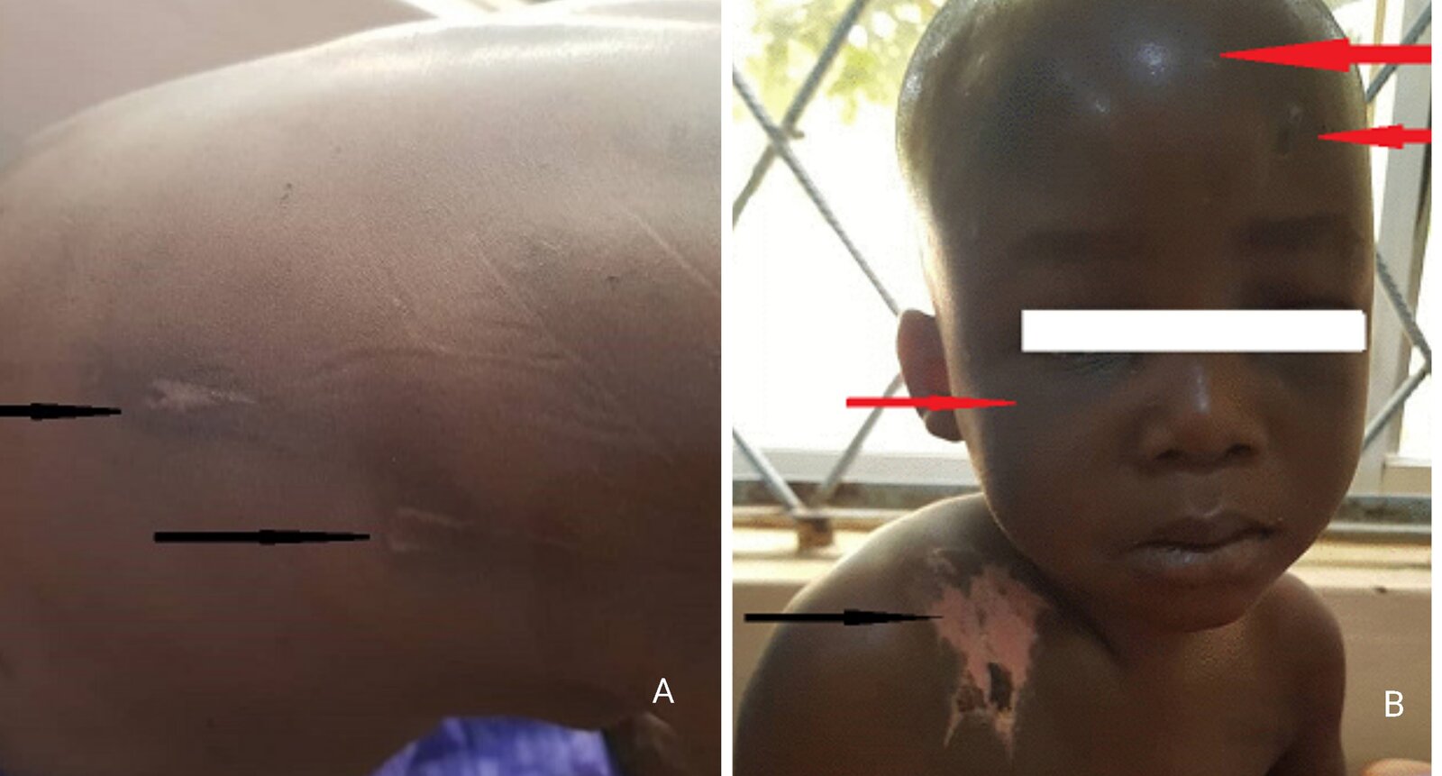 Injuries in physical child abuse