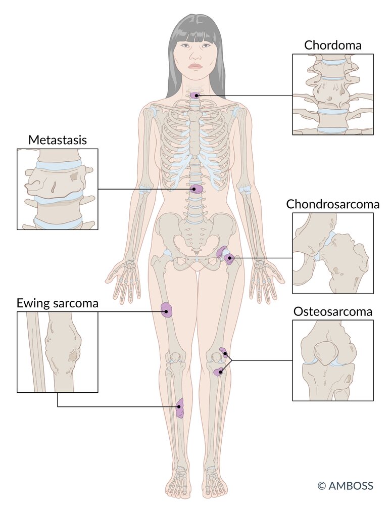 Typical locations of malignant bone tumors