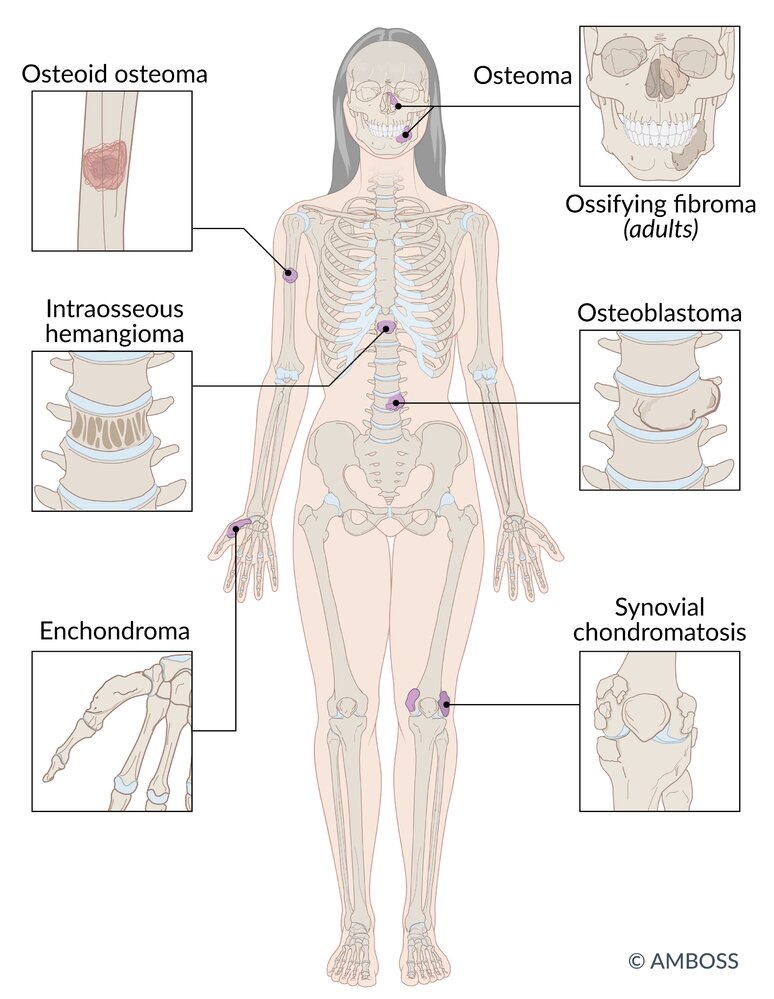 Typical locations of benign bone tumors