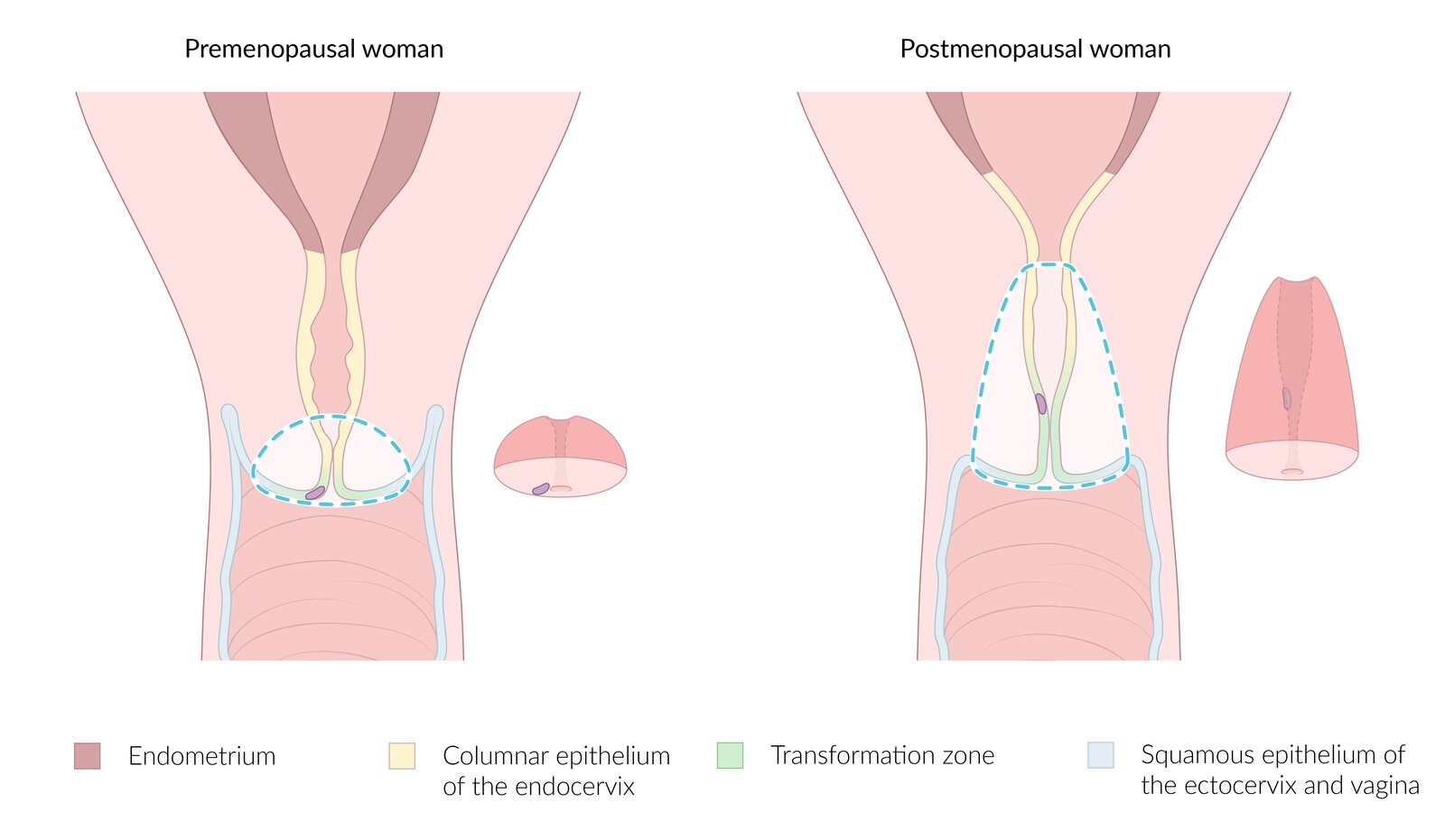 Cervical conization