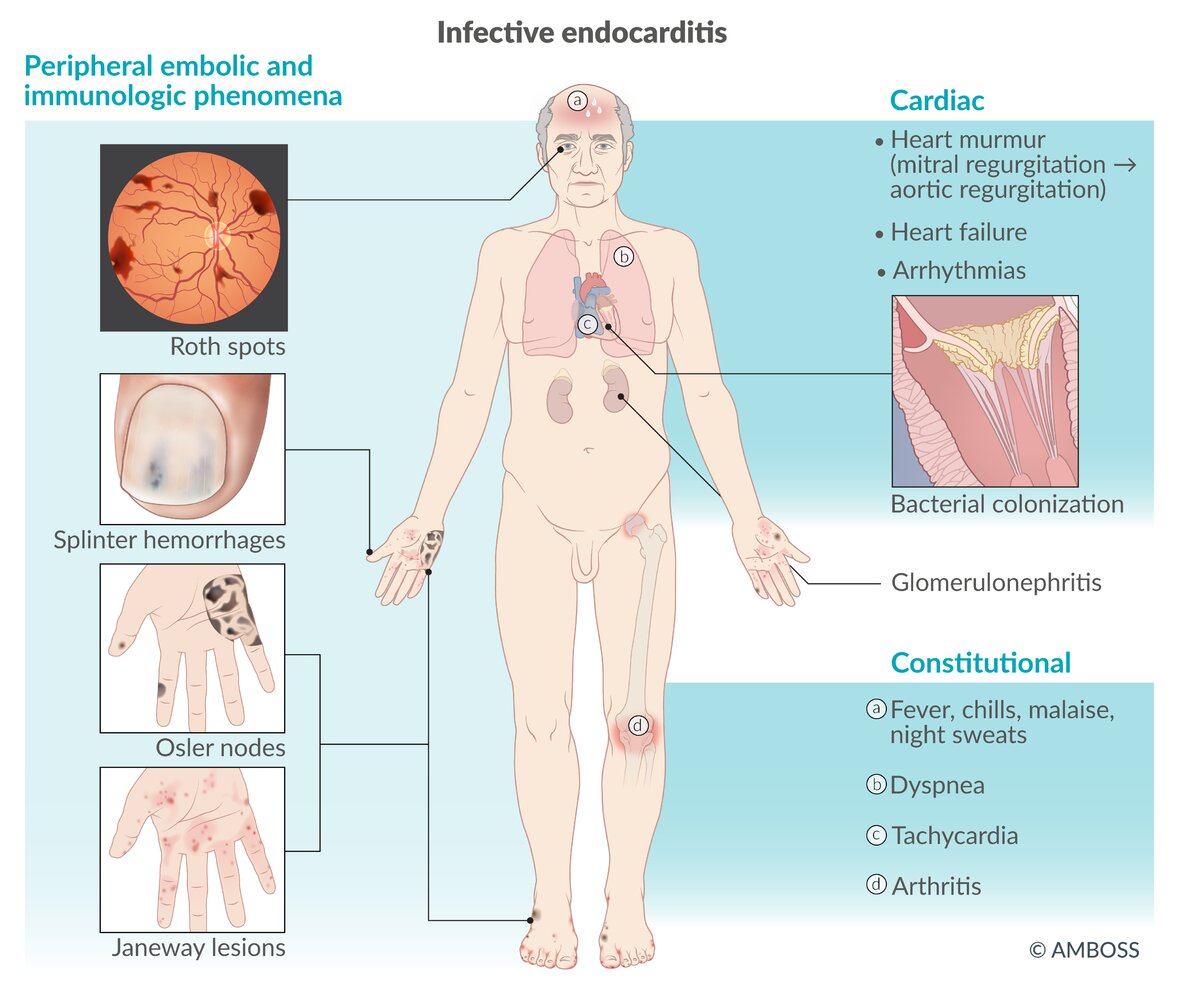 Clinical features of infective endocarditis