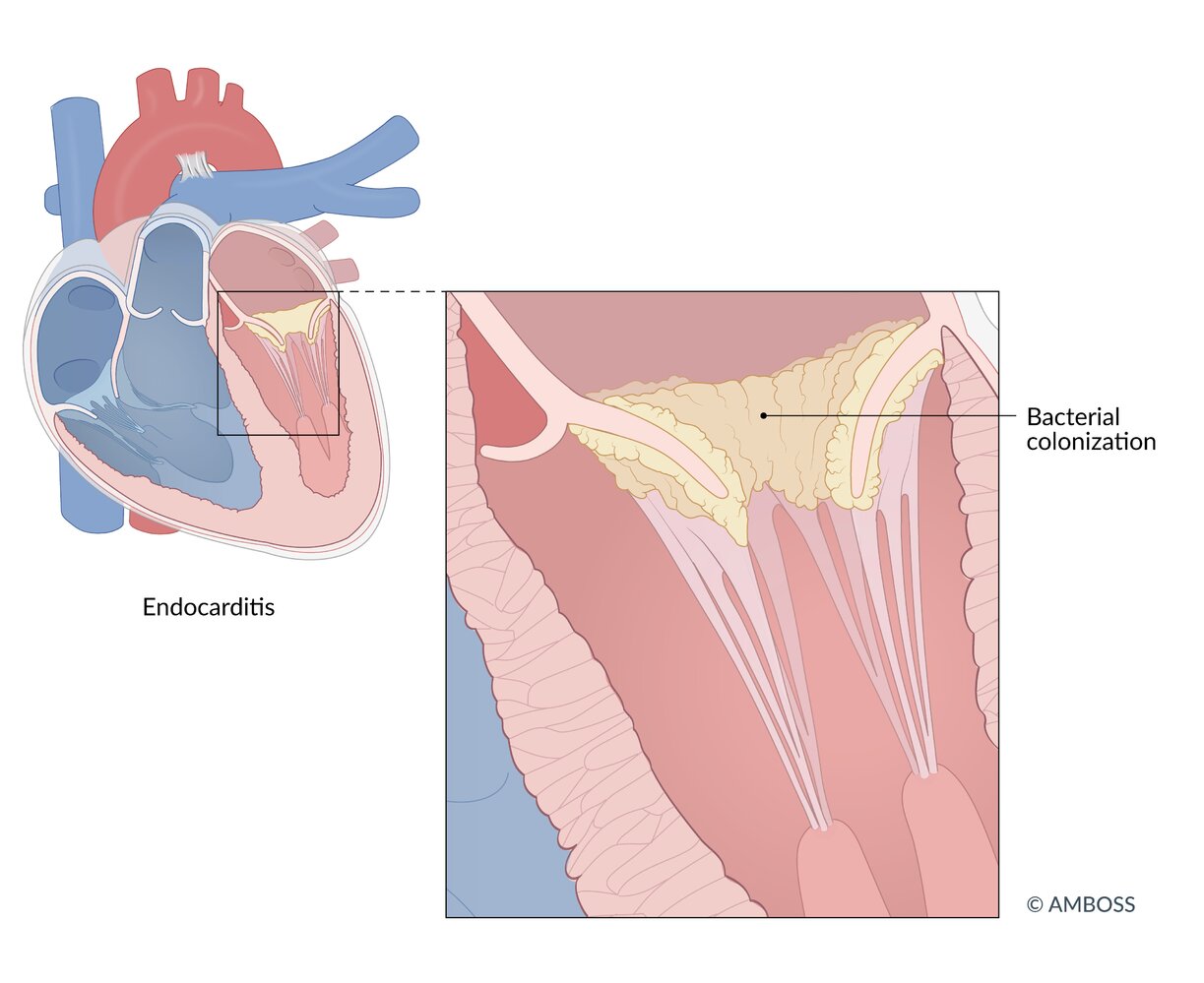 Infective endocarditis