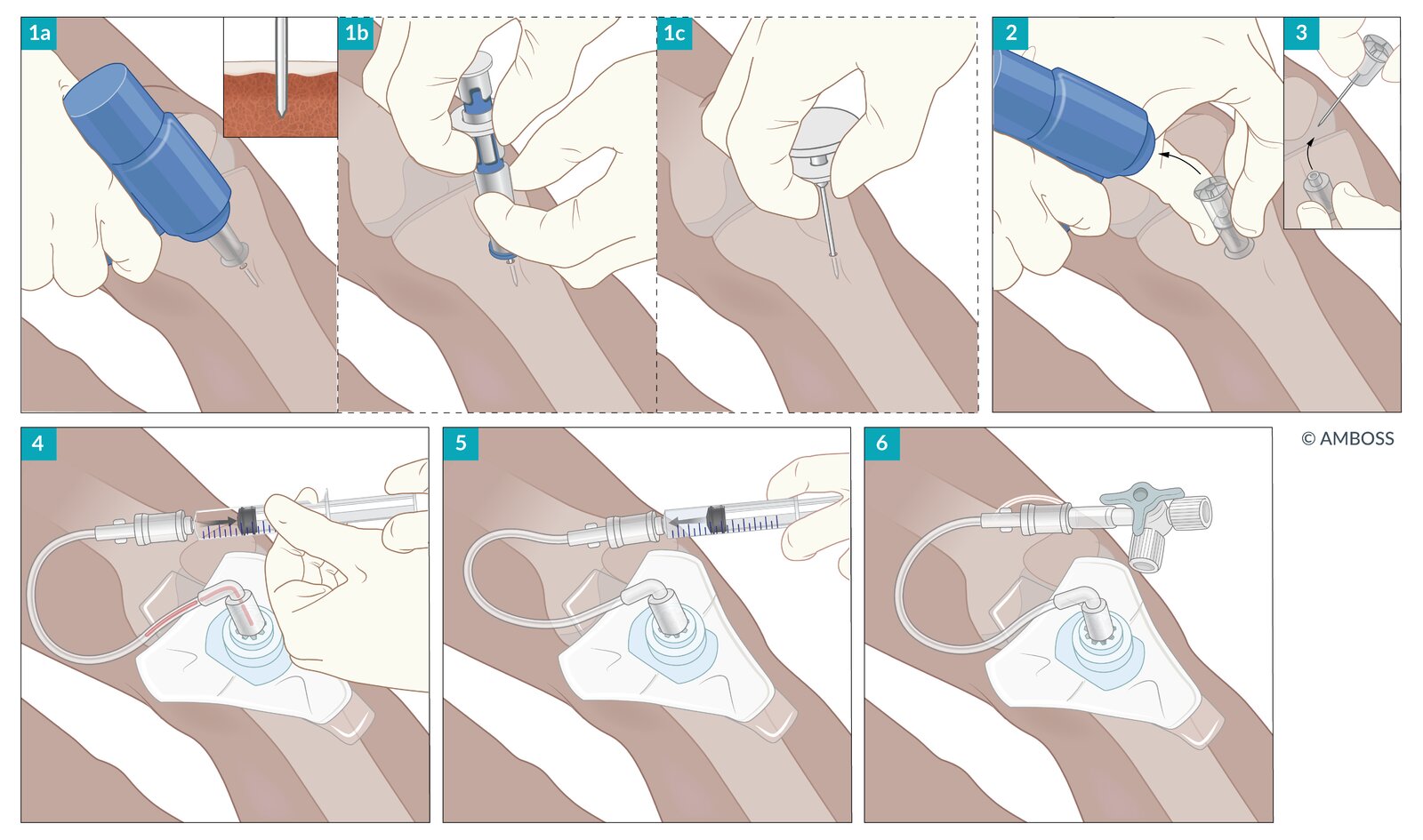 Intraosseous access
