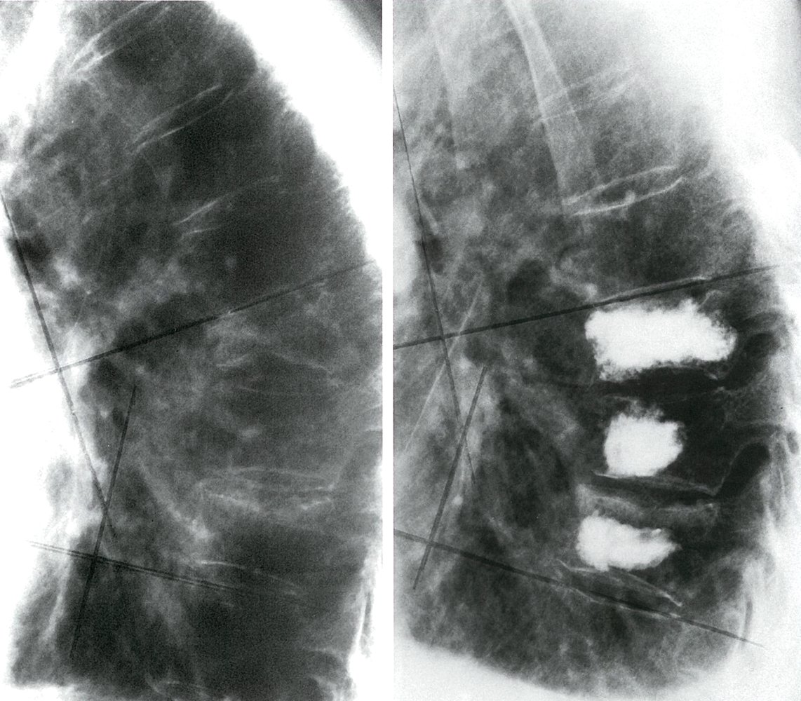 Vertebral body fractures with cement augmentation
