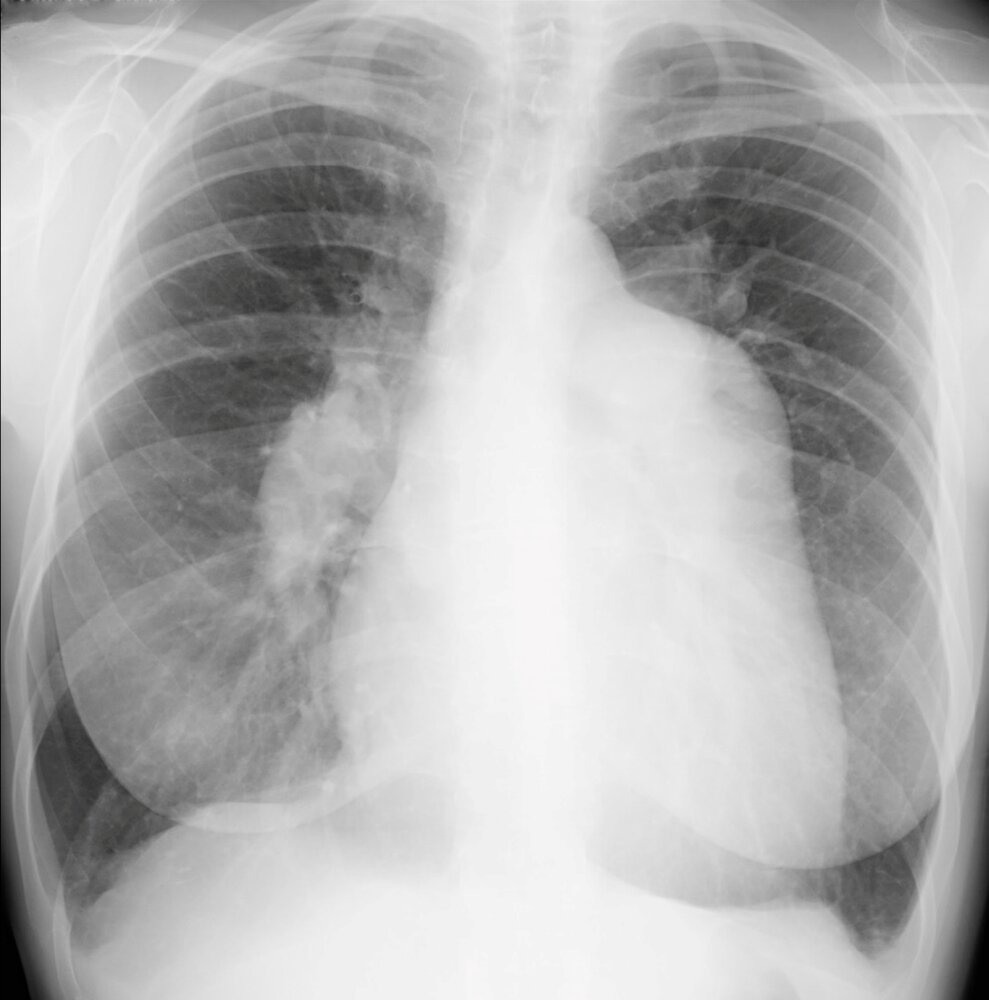 Pulmonary hypertension (1/2)