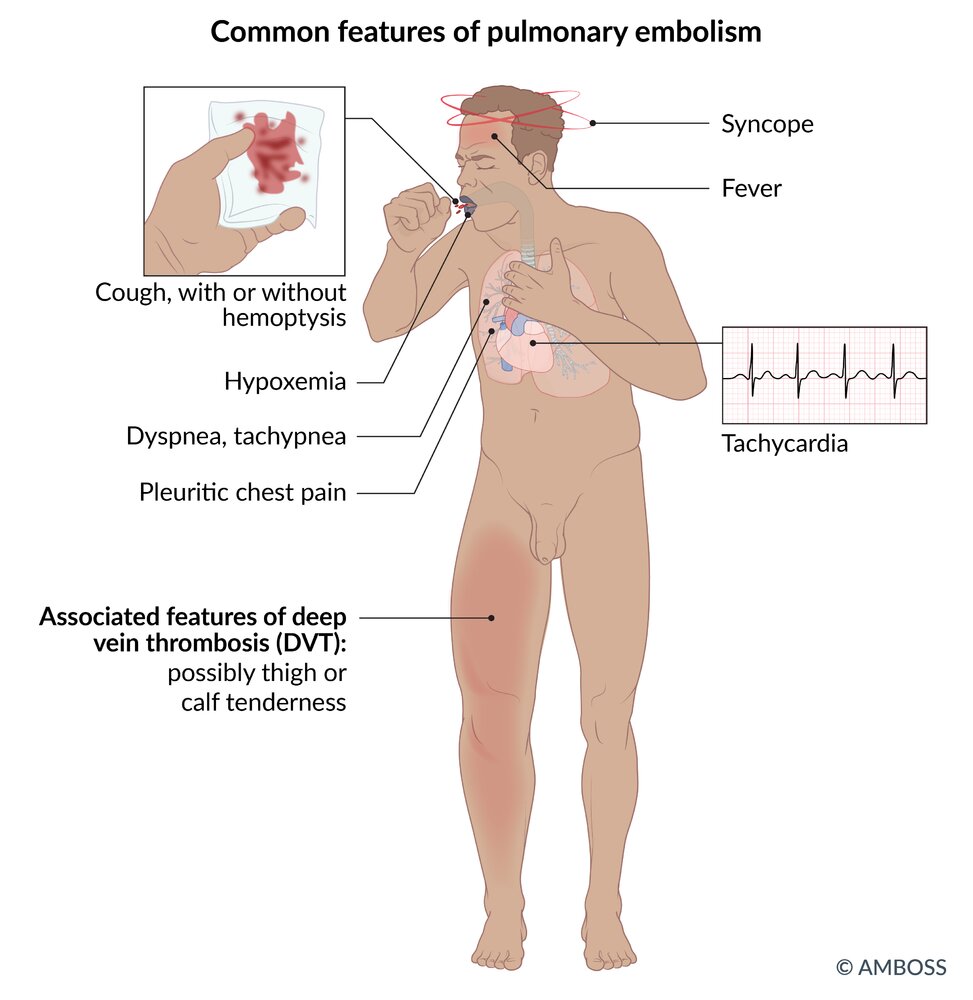 Clinical features of pulmonary embolism