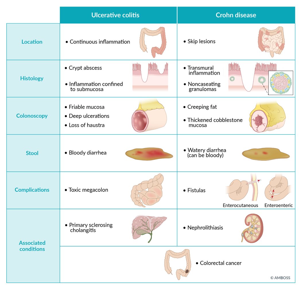 Ulcerative colitis vs. Crohn disease
