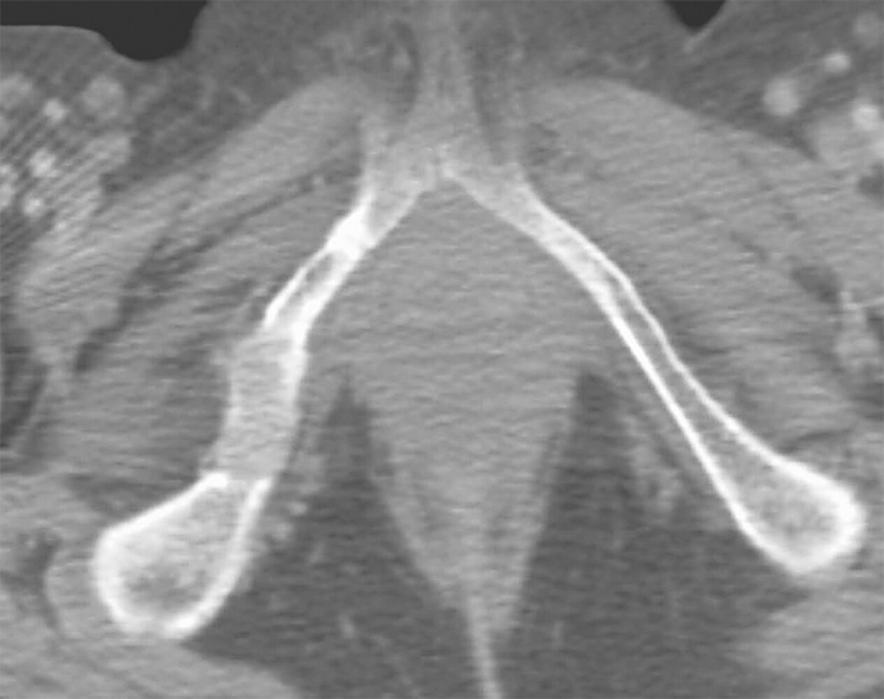 Osseous soft tissue lesion