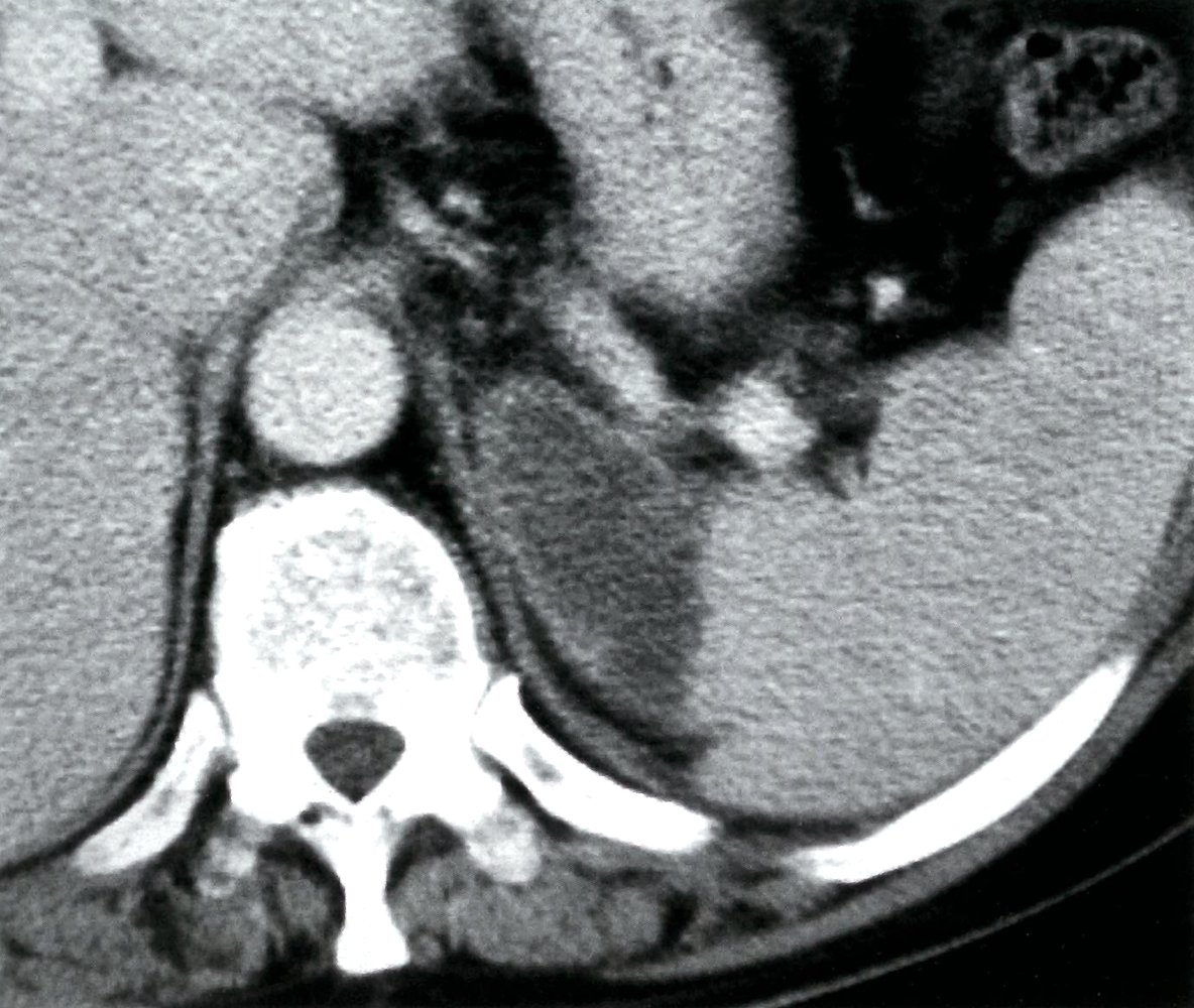 Splenic infarction