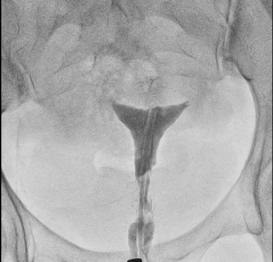 Nonfilling of fallopian tubes on hysterosalpingography