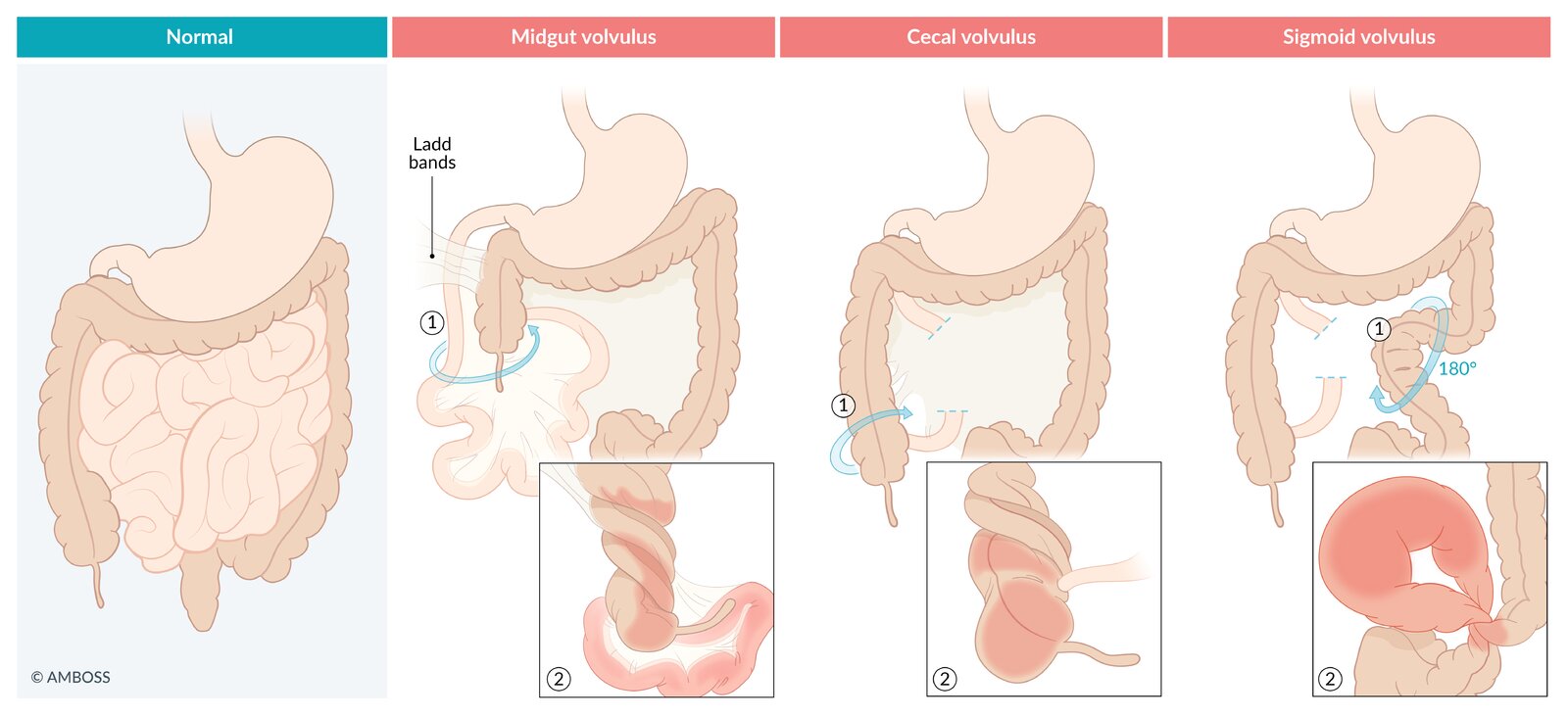 Types of volvulus