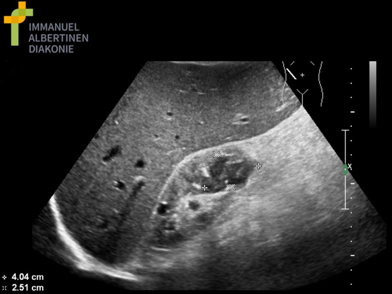 Renal mass